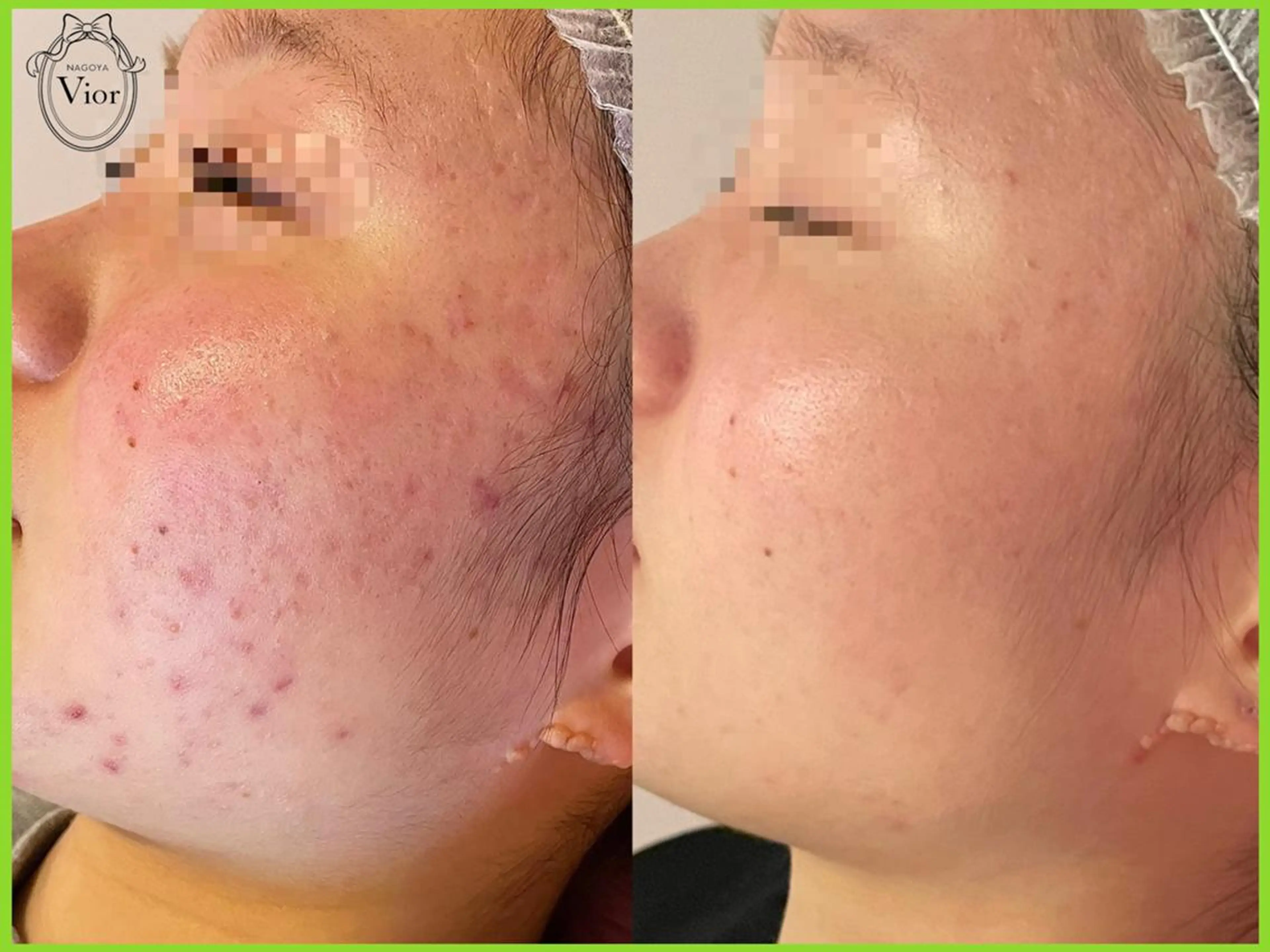 エステ 栄 VIO Rのエステ・リラクイメージ