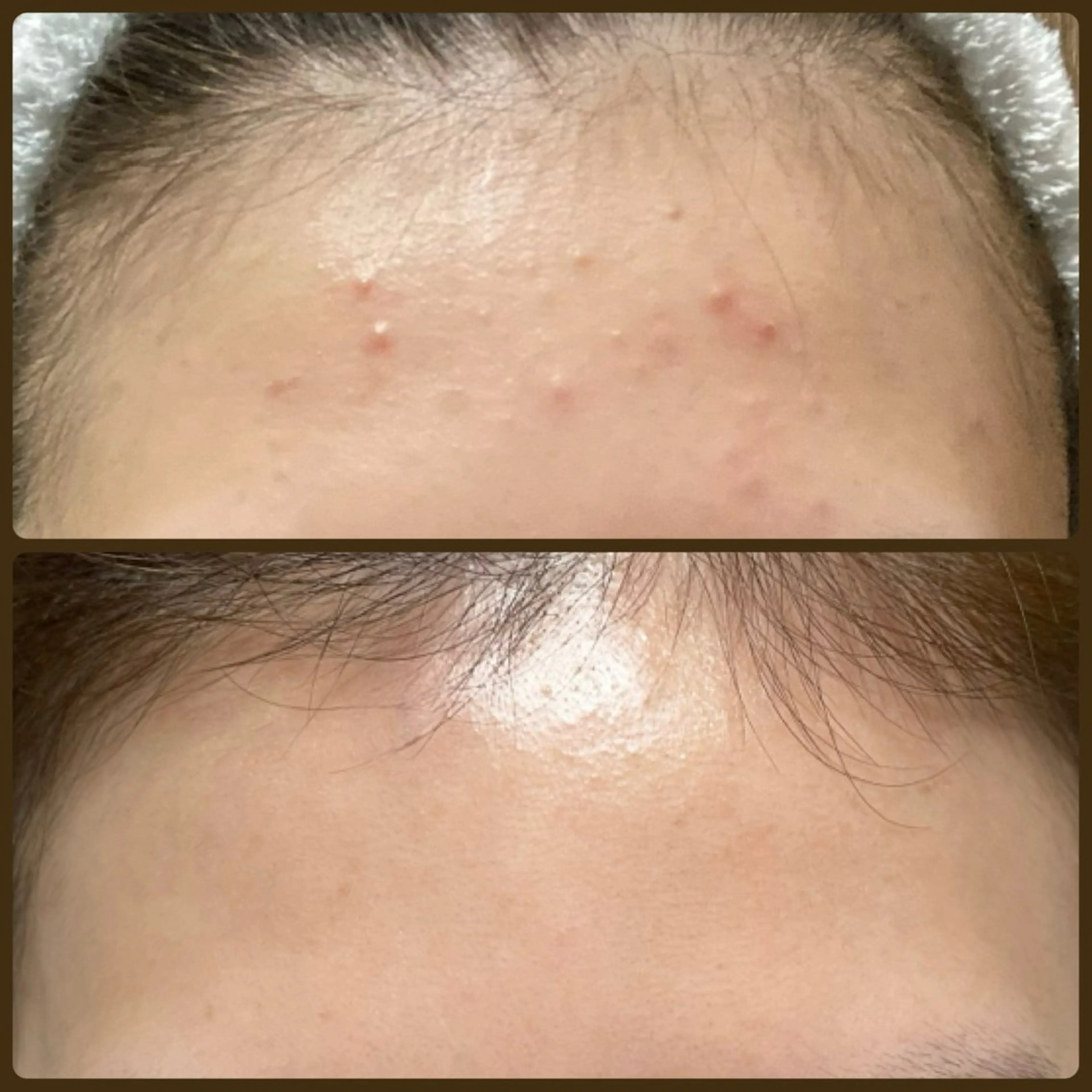 ニキビ・ 肌荒れ専門店のエステ・リラクイメージ