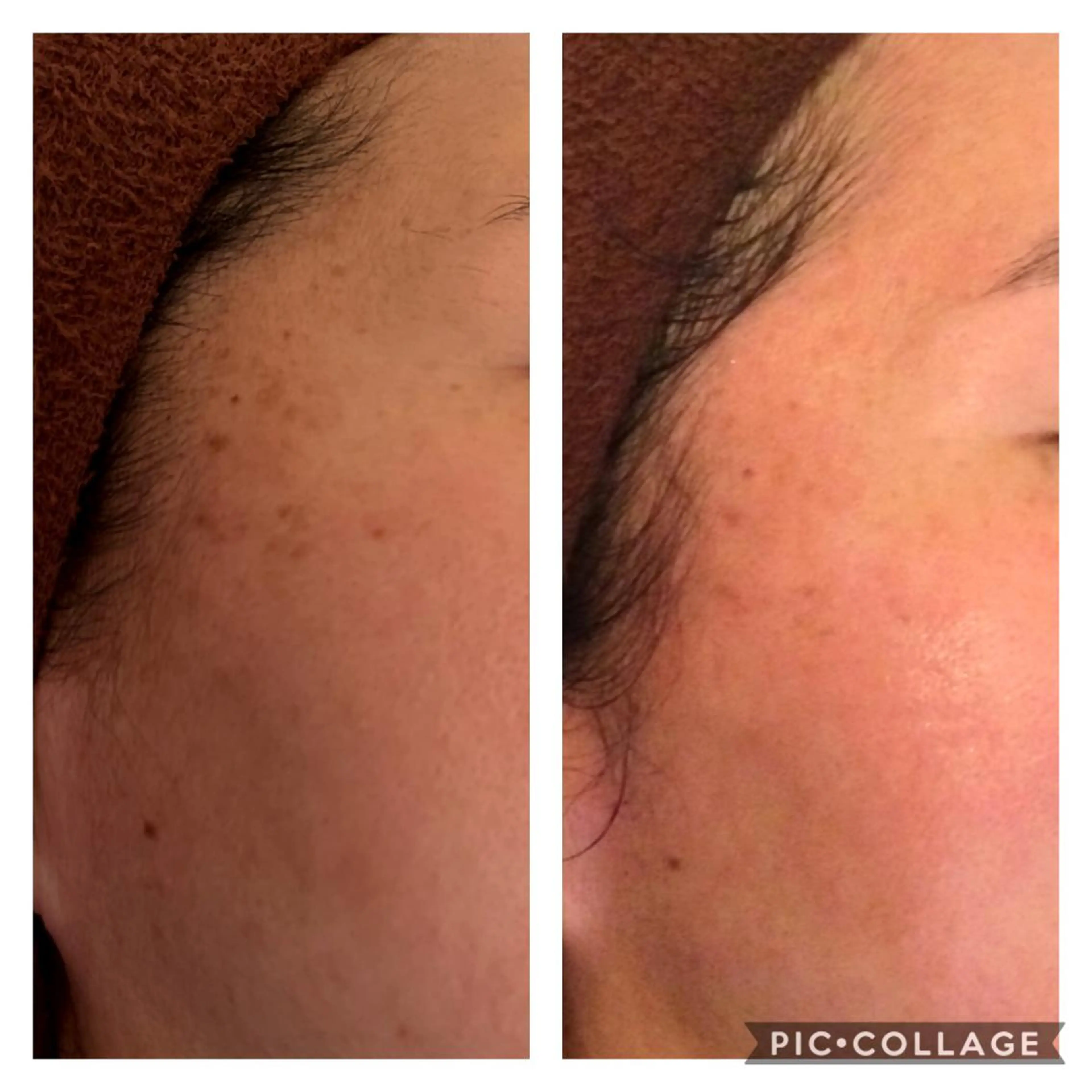 エステ リラク ニキビ/肌質改善専門 Snow skinのエステ・リラクイメージ