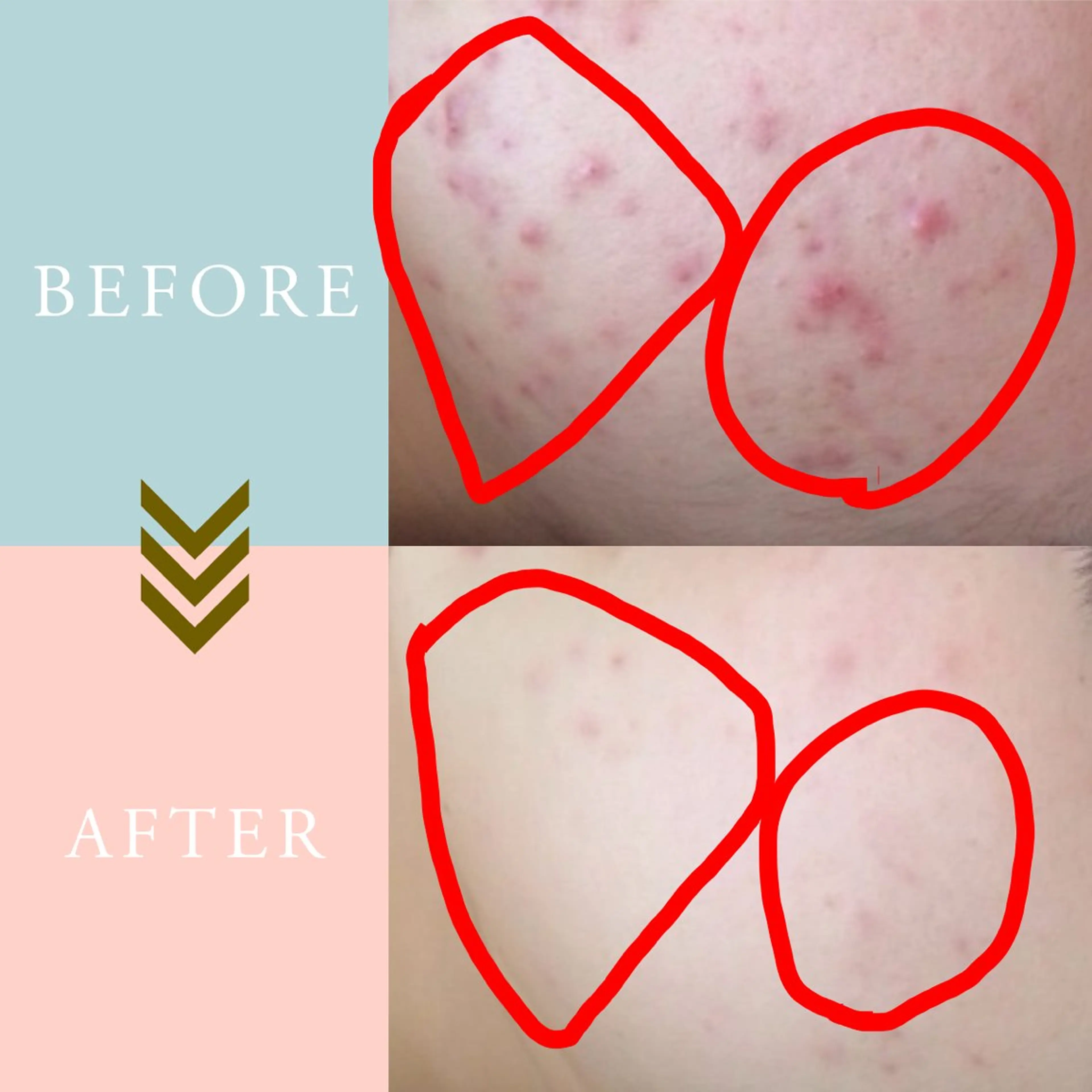 ニキビケア/毛穴/ 赤み/自信の肌✨森園のエステ・リラクイメージ