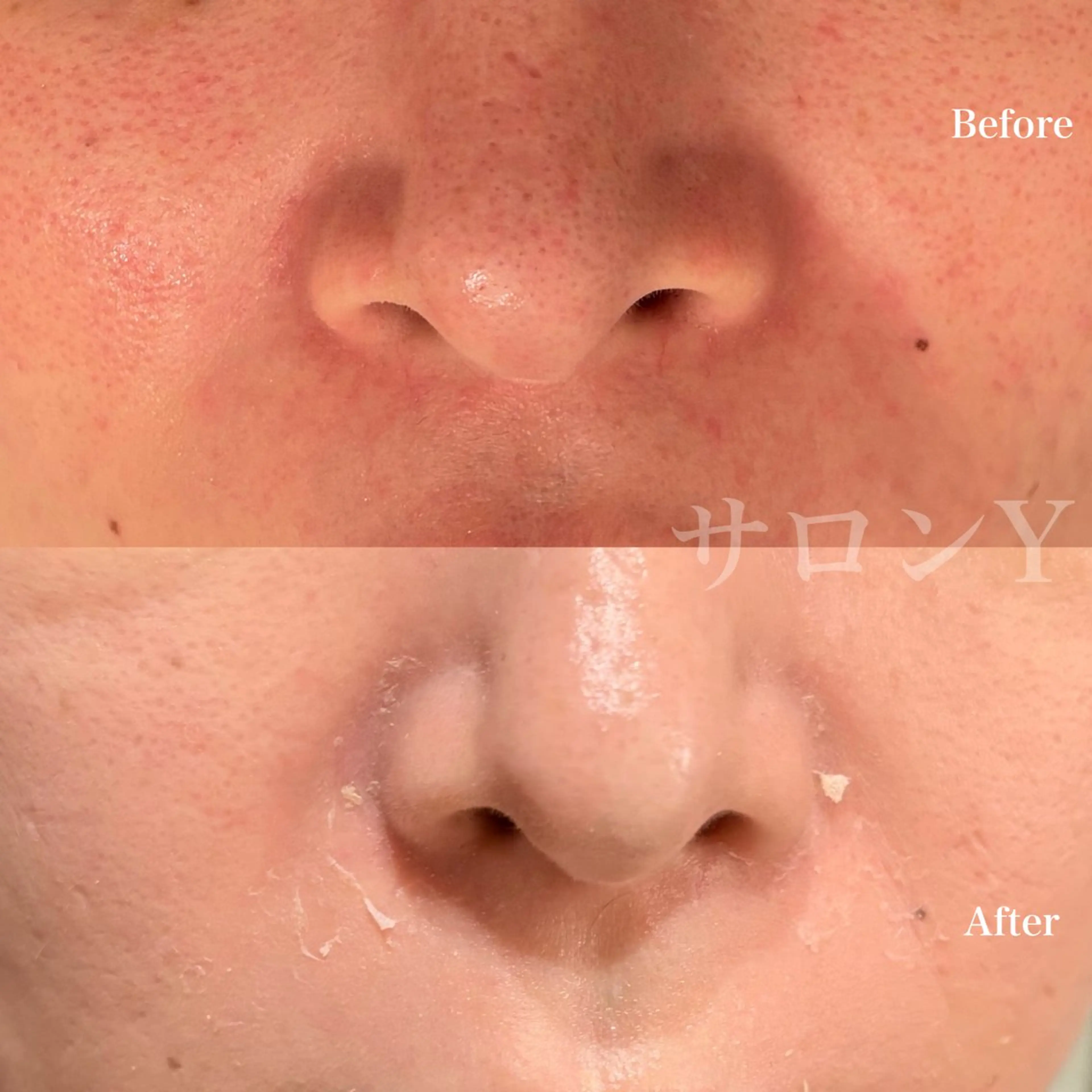 グリーンピールスペシャル1day《1日でツヤのあるお肌へ》の写真