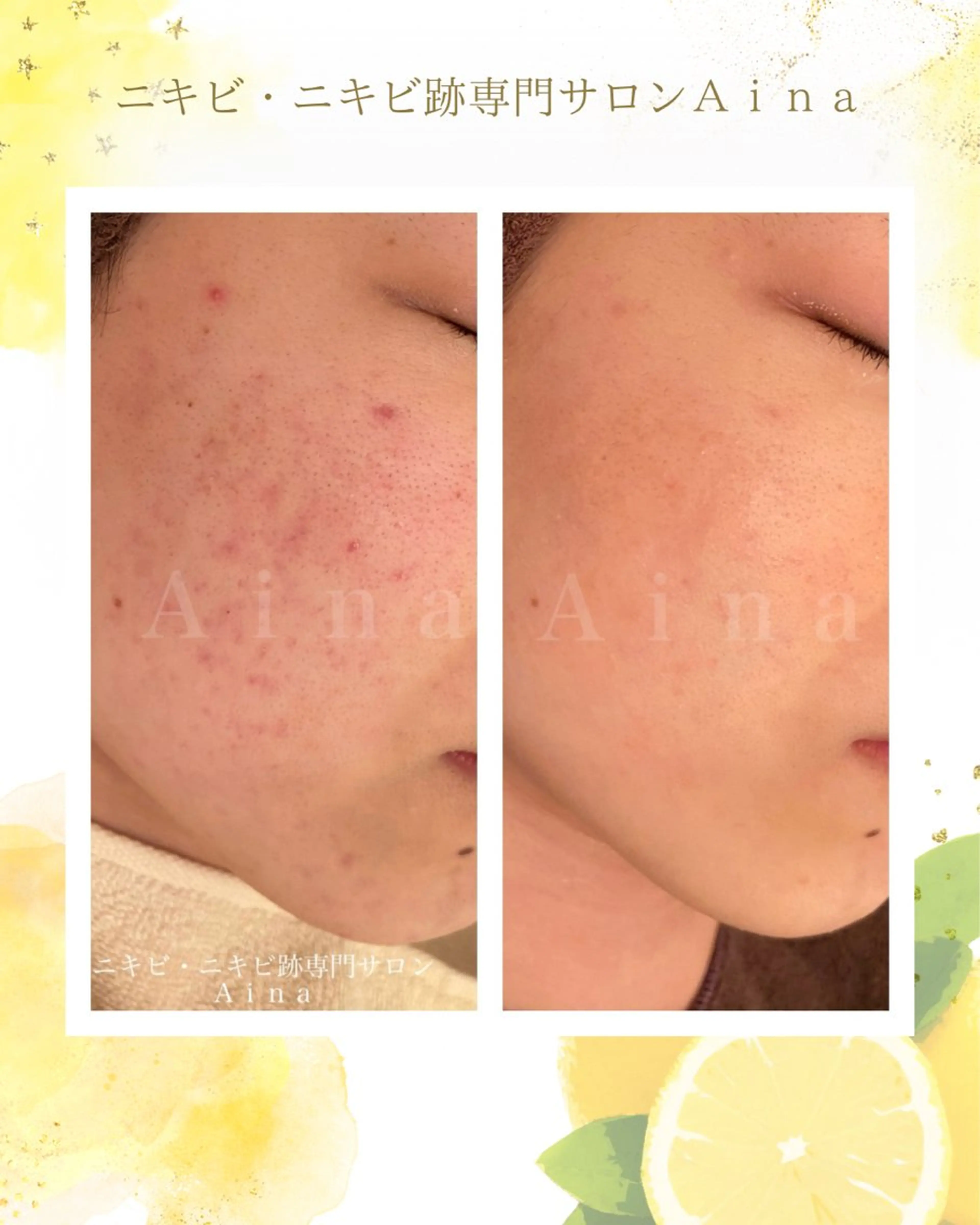エステ リラク ニキビ跡専門サロン Ainaのエステ・リラクイメージ