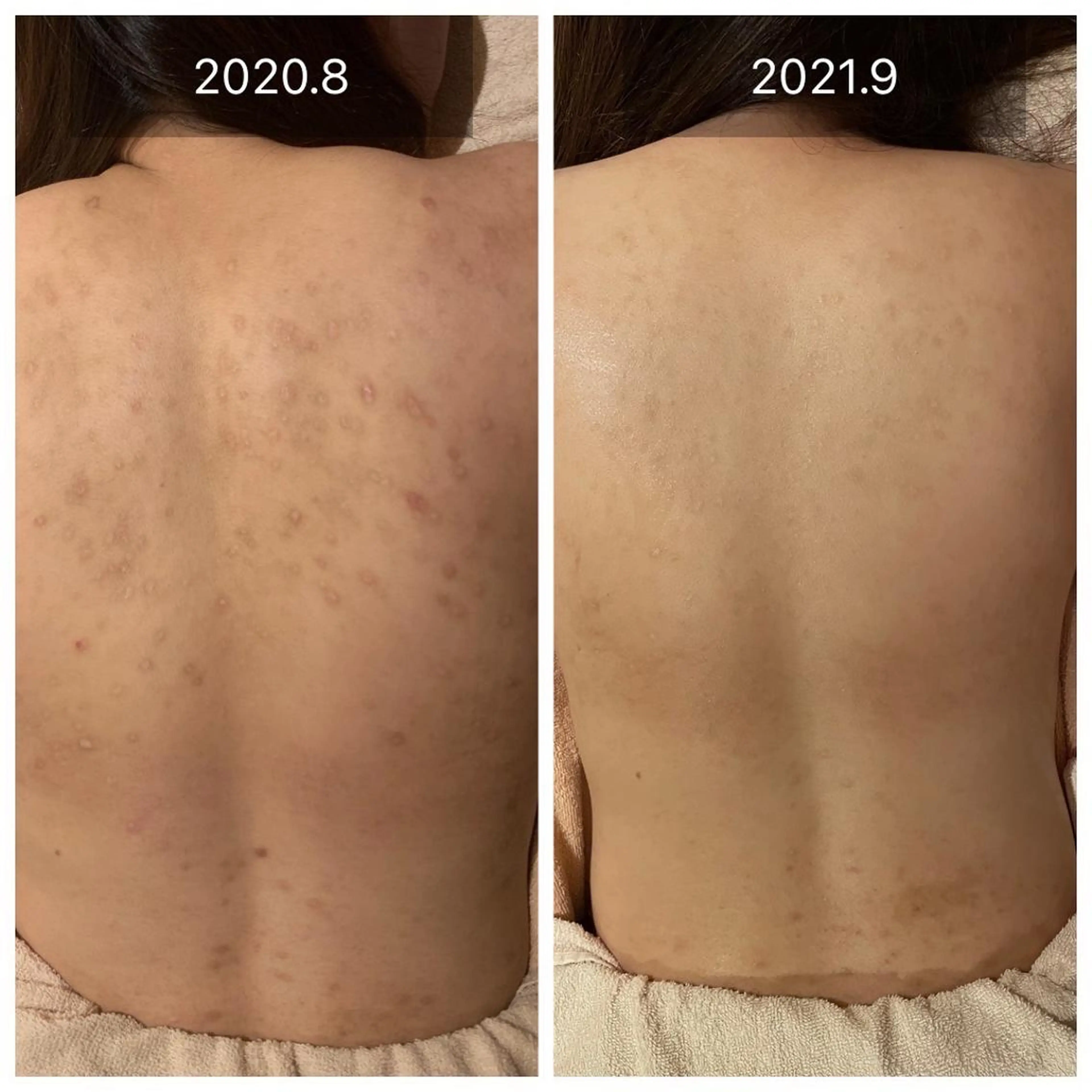 【💚背中を綺麗にしたい方💚】背中ハーブピーリングでツルツル🌿😭ニキビ・ニキビ跡・ザラつき・色素沈着を改善❣️の写真