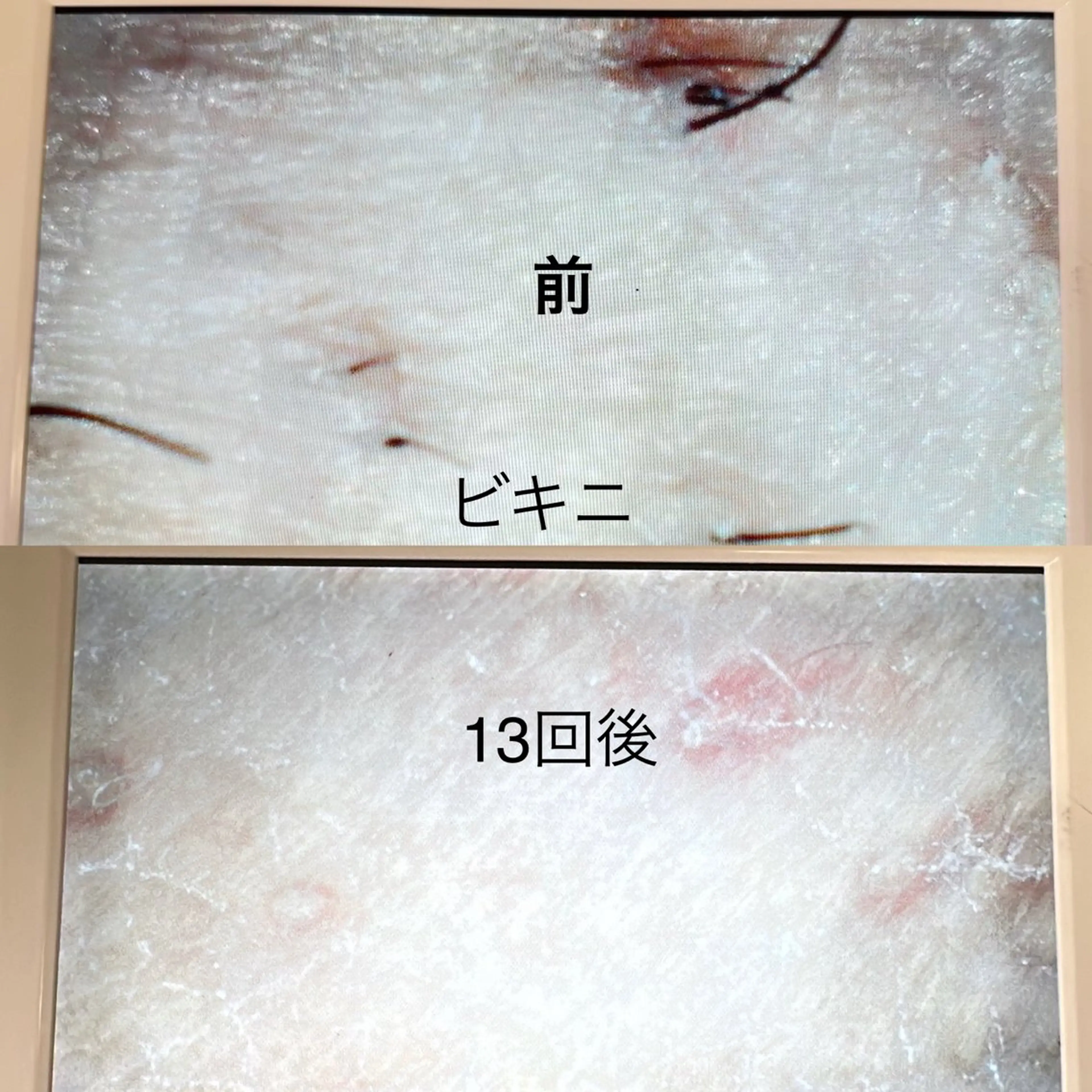 ビキニライン脱毛 – 8回コース 40,000円の写真