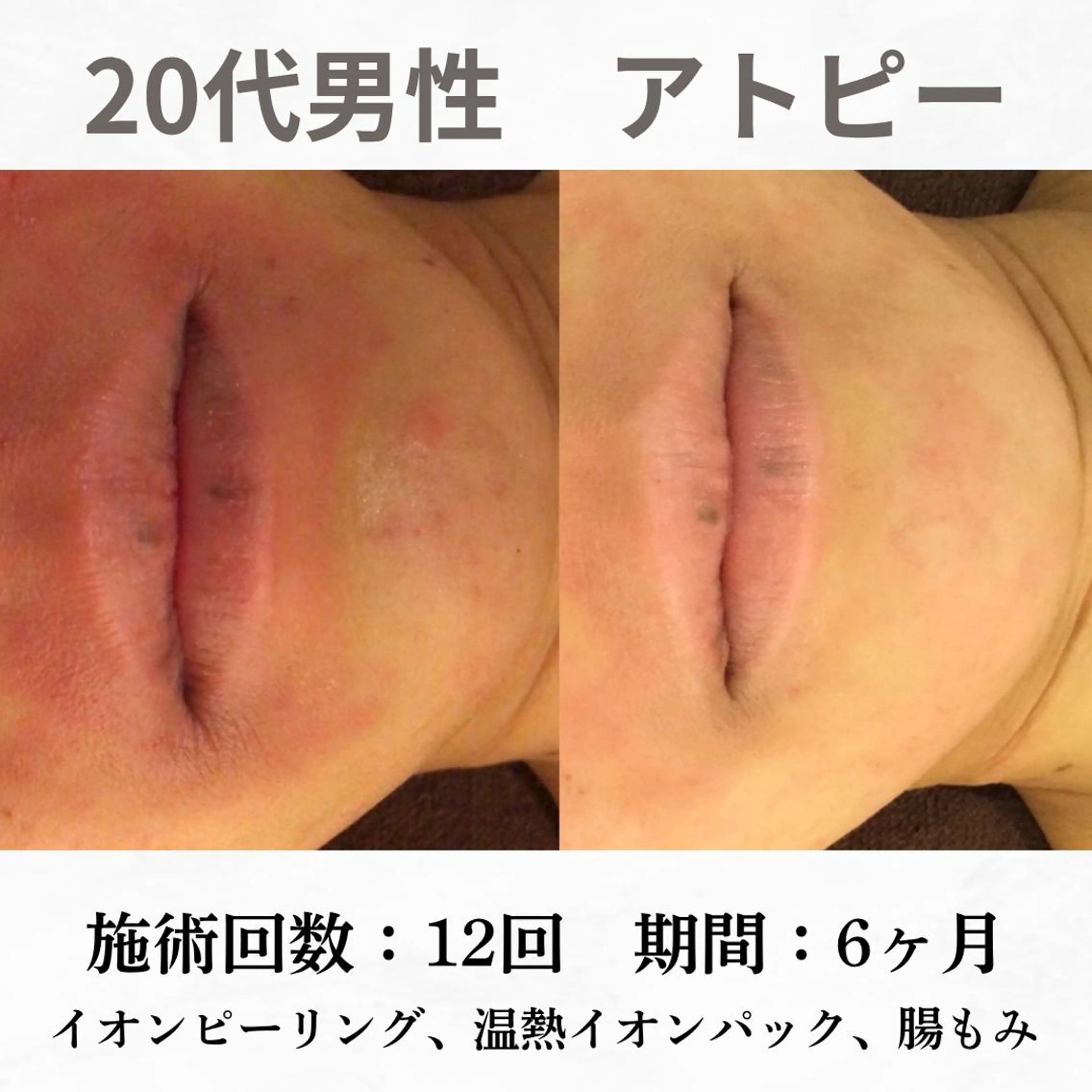 重度ニキビ専門🌷 ダウンタイムなしのエステ・リラクイメージ