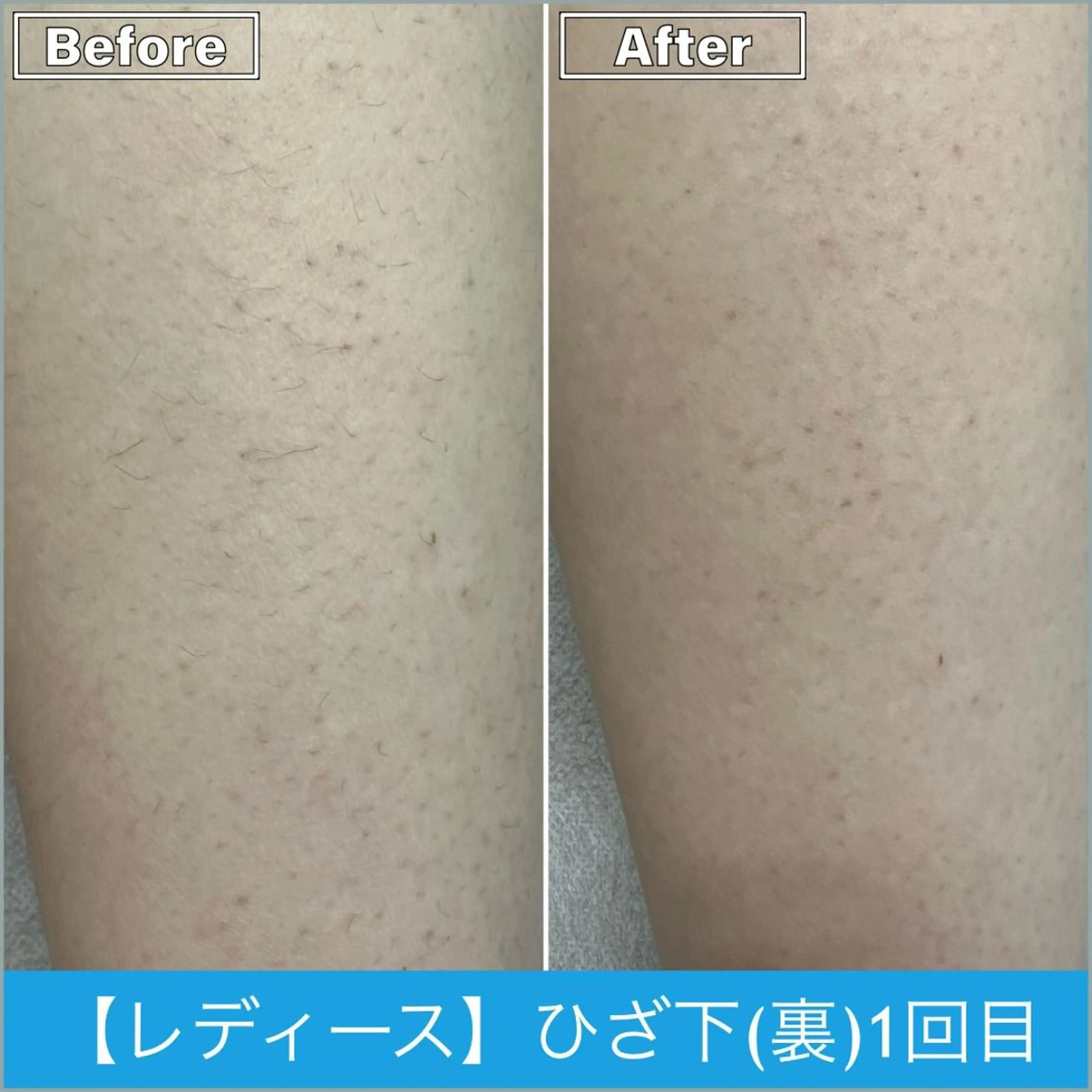 脱毛 プライベートサロンシャルム所属・プライベートサロン シャルムのその他イメージ