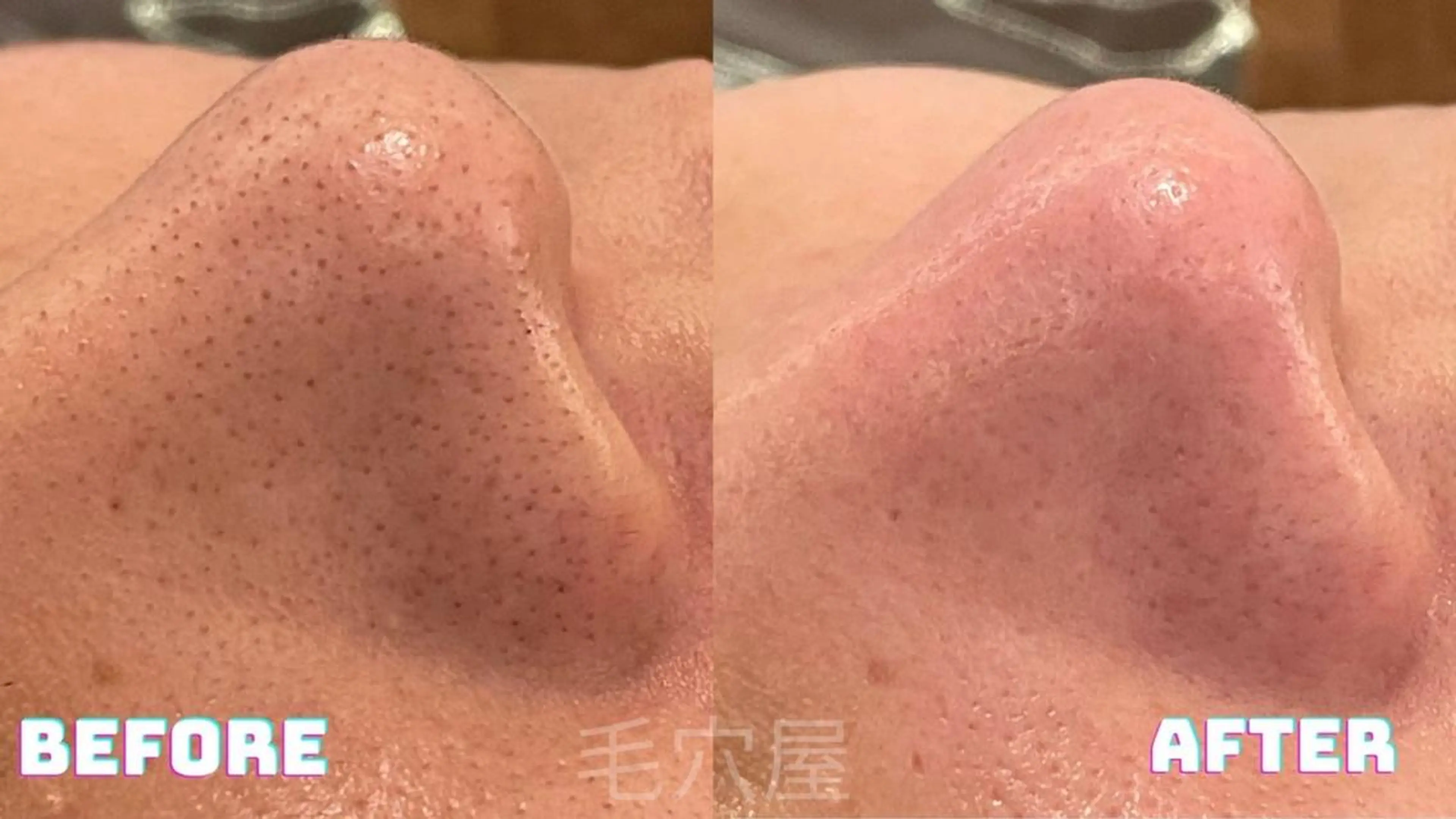 エステ 毛穴/毛穴洗浄専門 エミルカ船橋のエステ・リラクイメージ