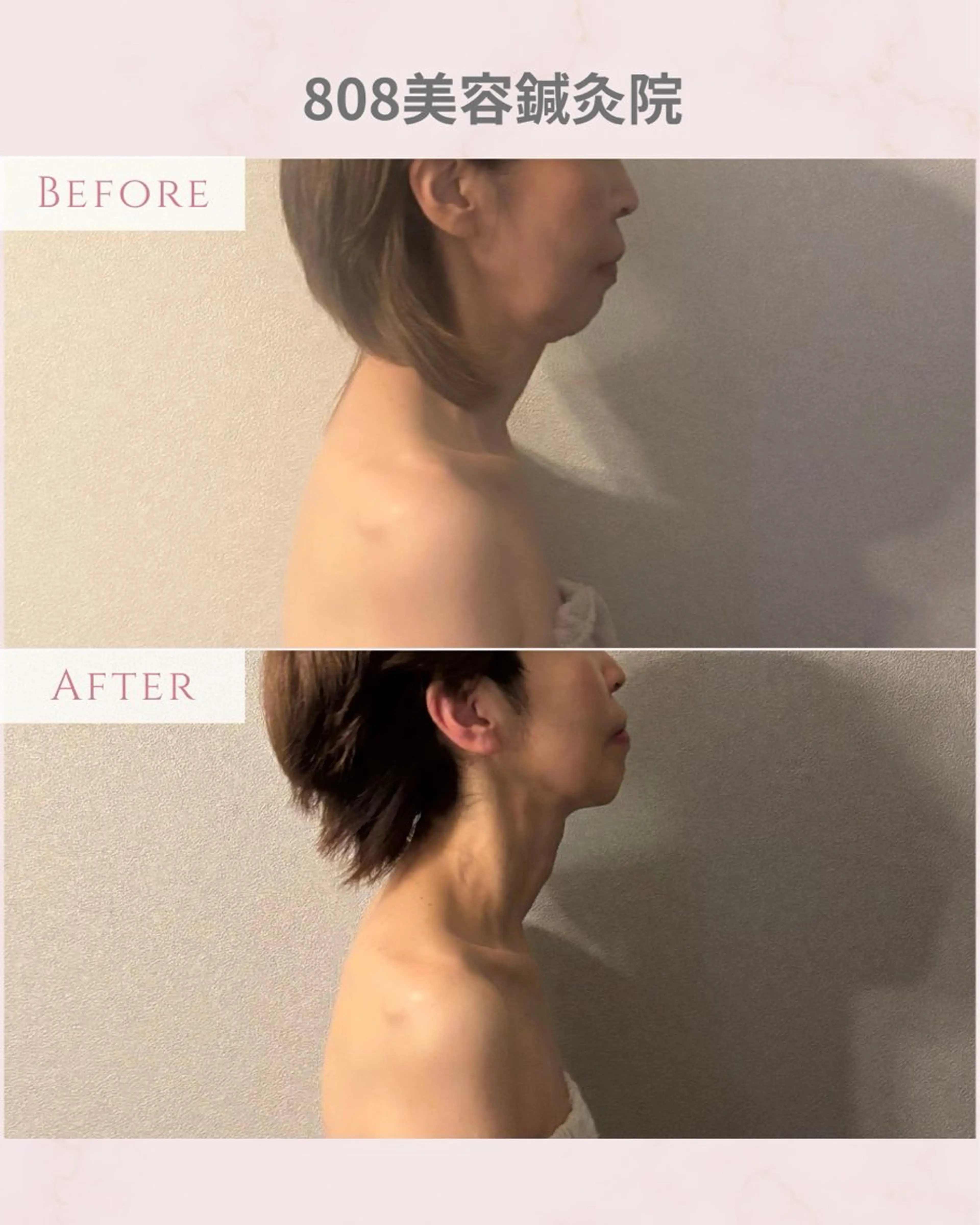 エステ 圧倒的たるみ改善 美容鍼エステのエステ・リラクイメージ