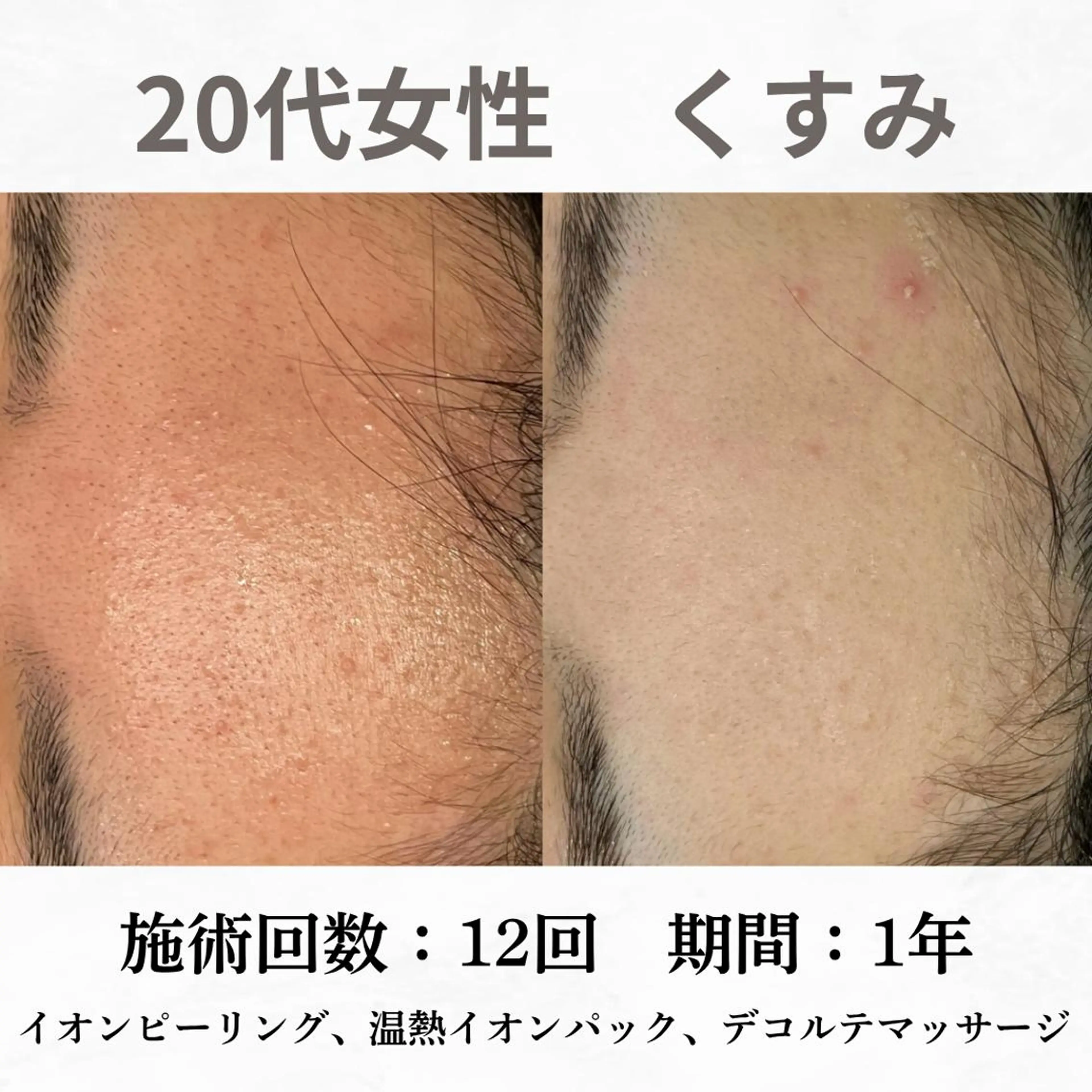 重度ニキビ専門🌷 ダウンタイムなしのエステ・リラクイメージ