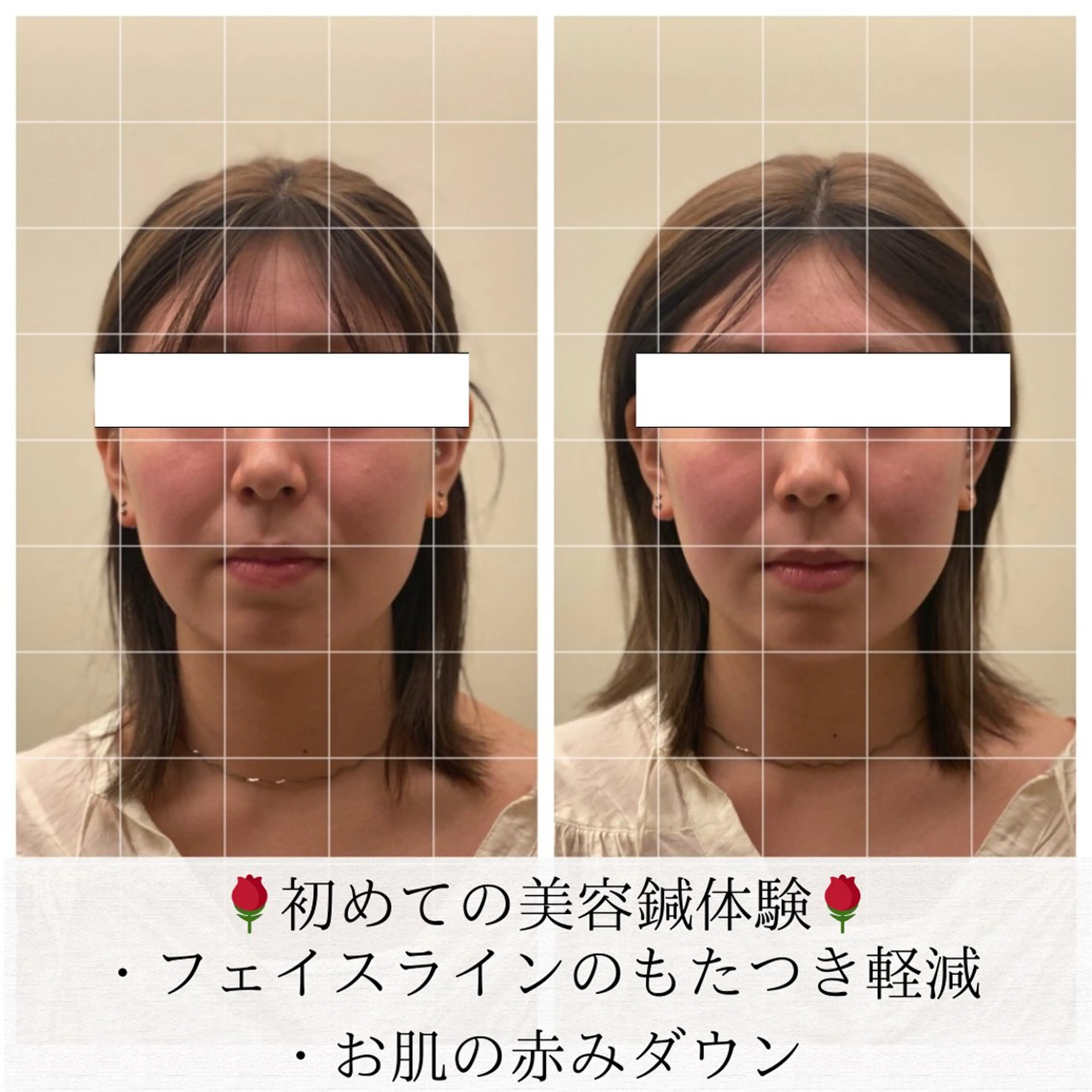 美容鍼/ヘッドスパ/ 💎さかもとのエステ・リラクイメージ