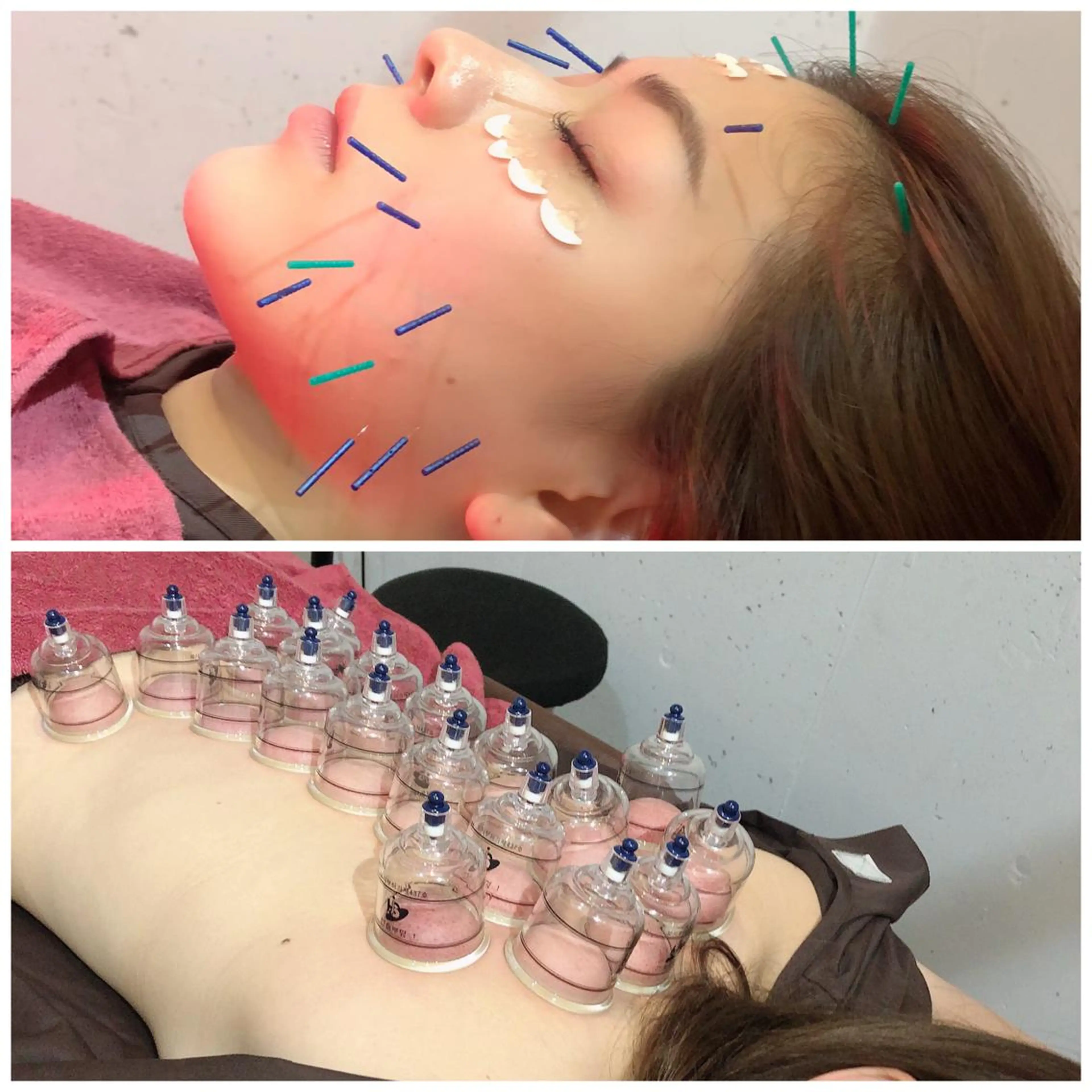 オススメ❣️お任せ美容鍼＋吸い玉90分コースの写真
