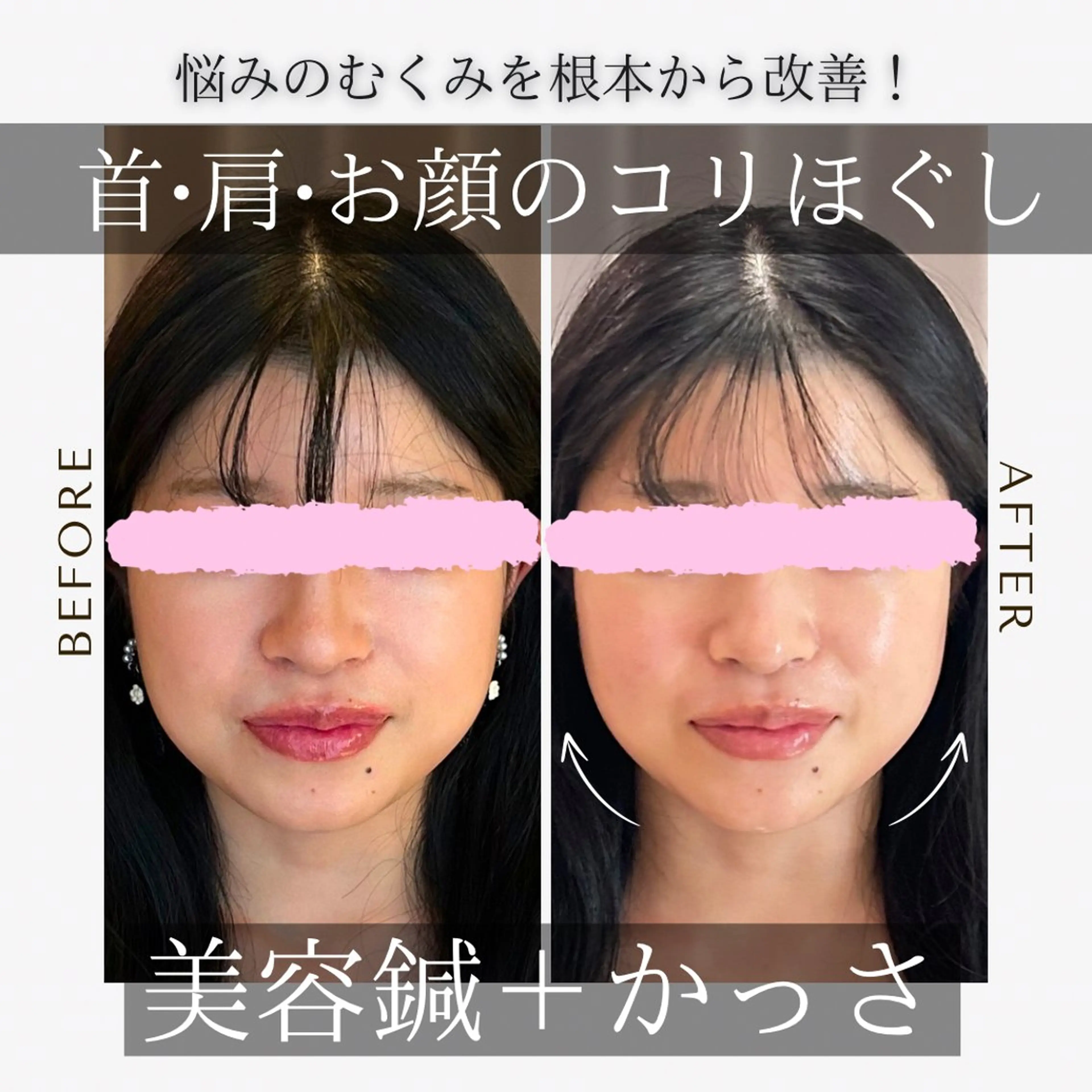 エステ リラク 鍼灸•マッサージサロンCalfa所属・《美肌･小顔》美容鍼 ＆マッサージ＊MEIのエステ・リラクイメージ