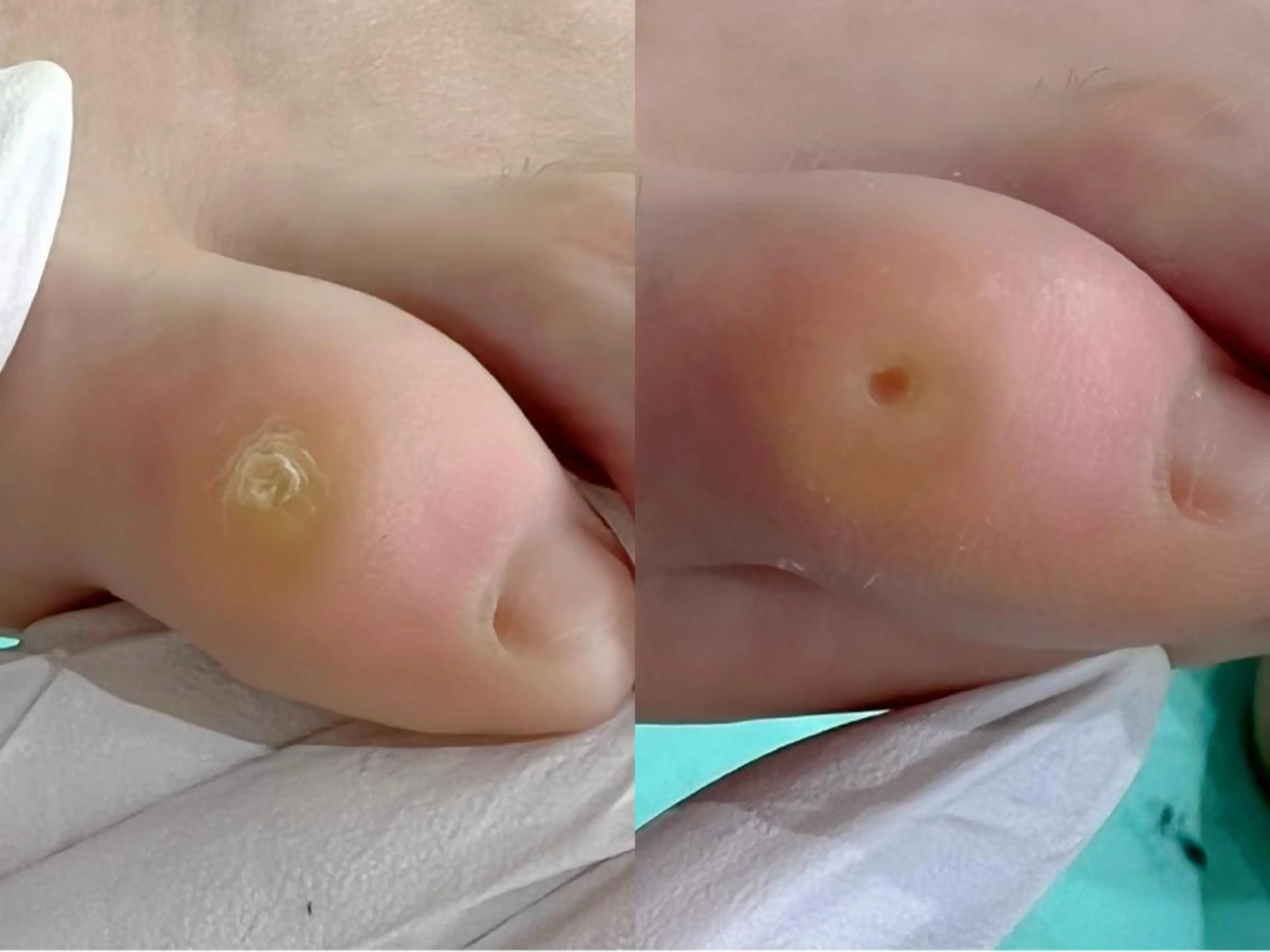 【一度で痛みを緩和◎】魚の目ケア　4000円の写真