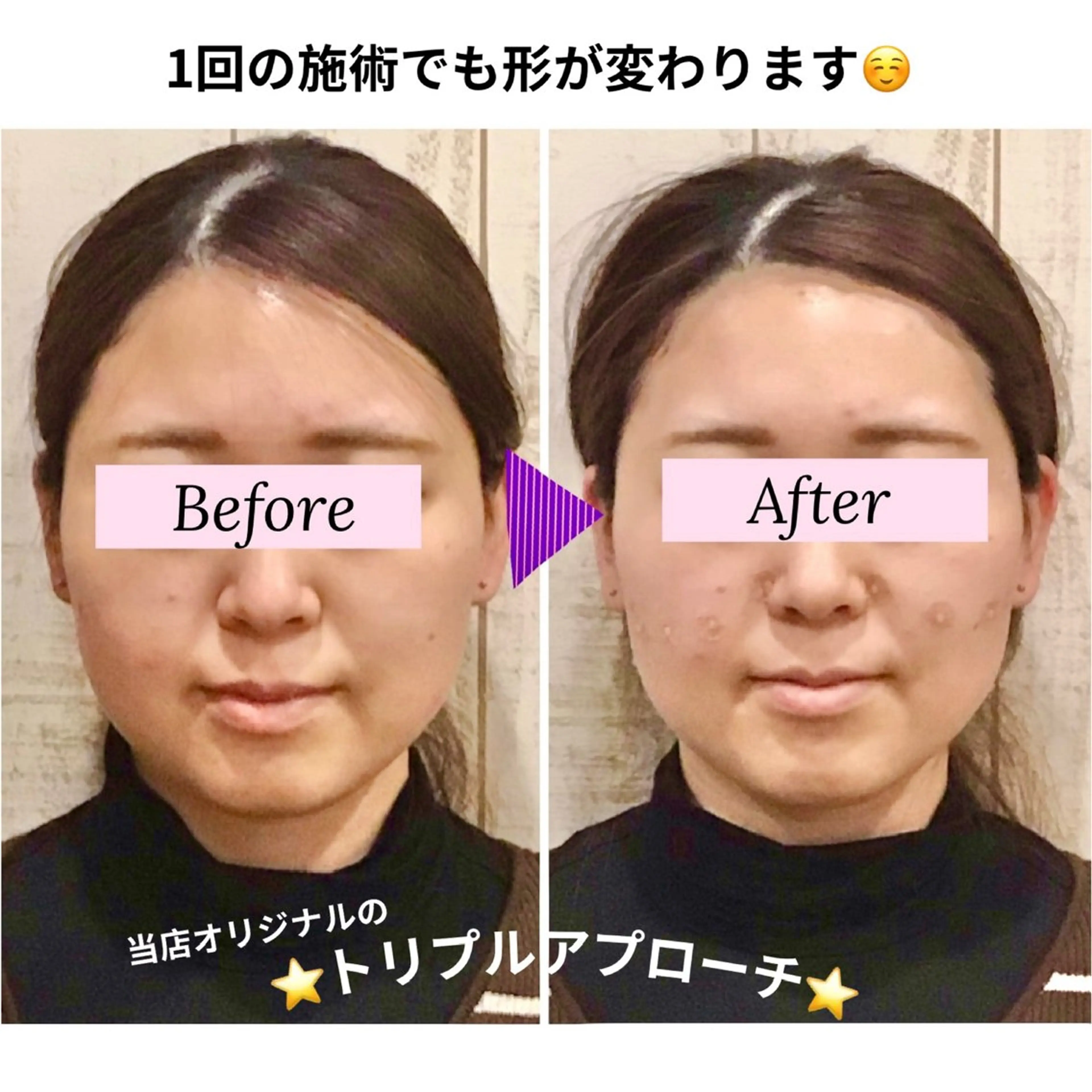 【肌の代謝❤️‍🔥美肌育成に⭕️】フル小顔矯正＋毛穴洗浄🫧＋ラジオ波で毛穴もフェイスラインもキュッと上がる👰‍♀️の写真