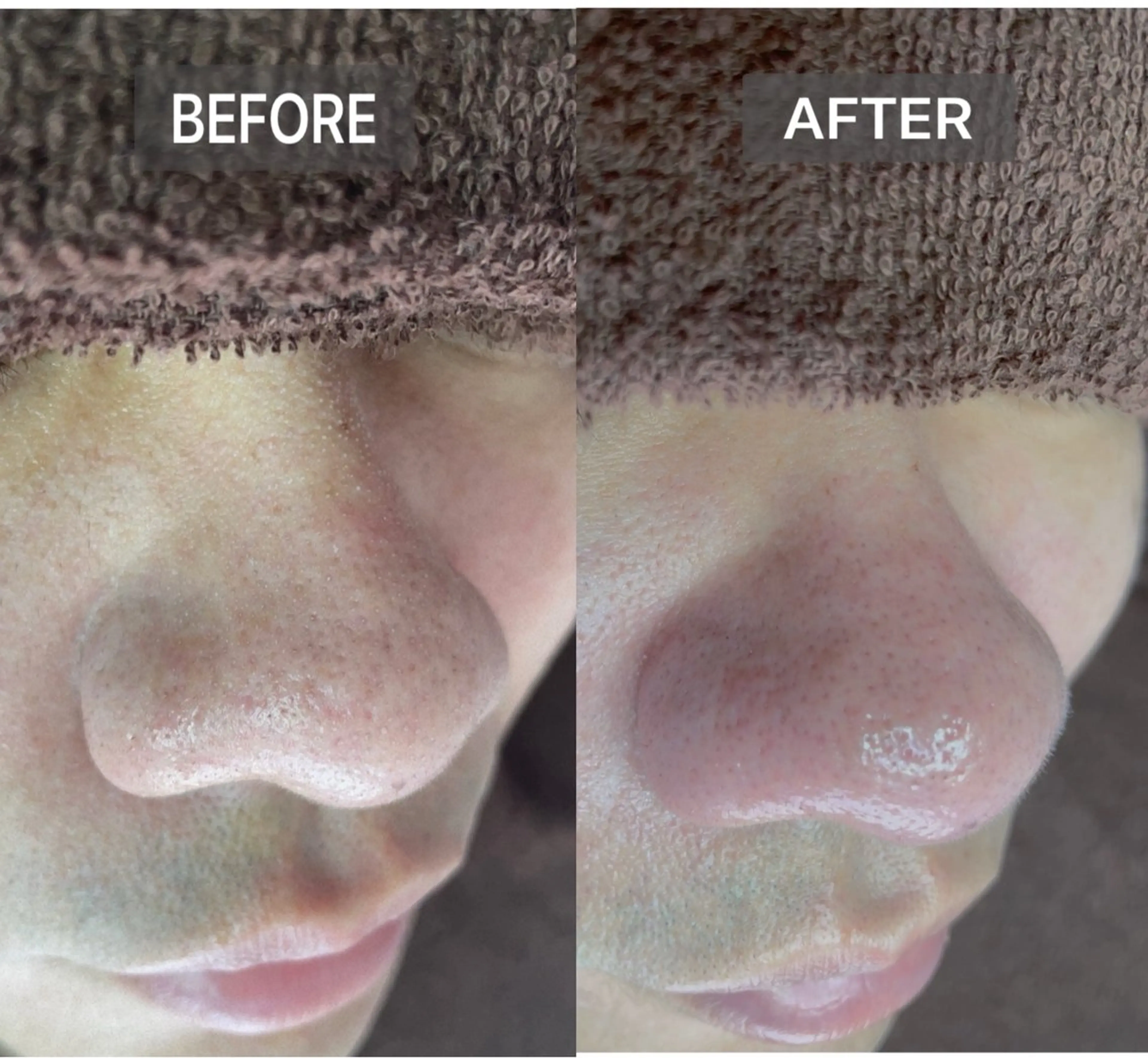 【詰まった角栓、黒ずみ毛穴、ざらつきなどでお悩みの方必見】直接角栓を押し出しツルツルに！毛穴エクストラクションコースの写真