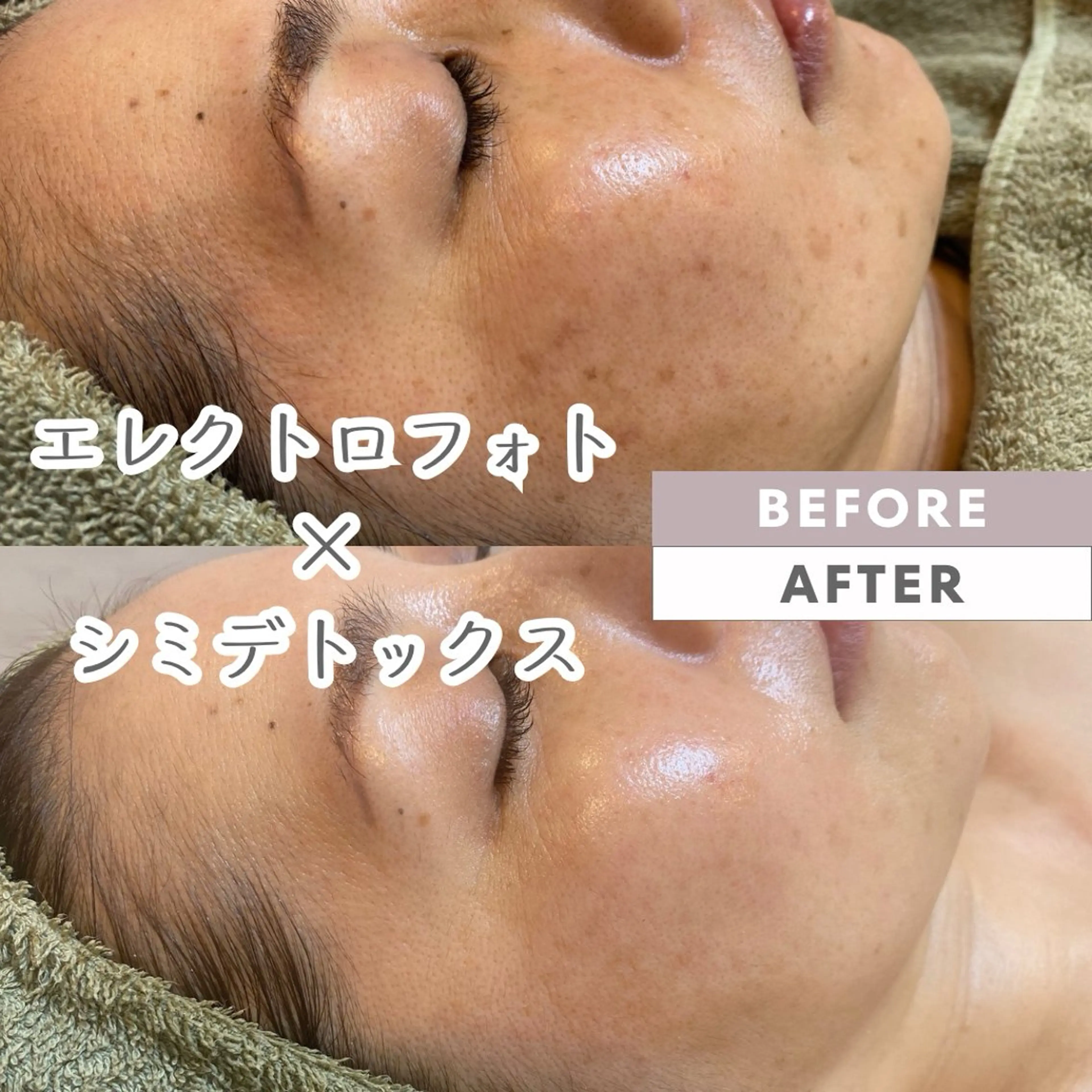 その他 脱毛｜ピーリング ROOM.Sのエステ・リラクイメージ