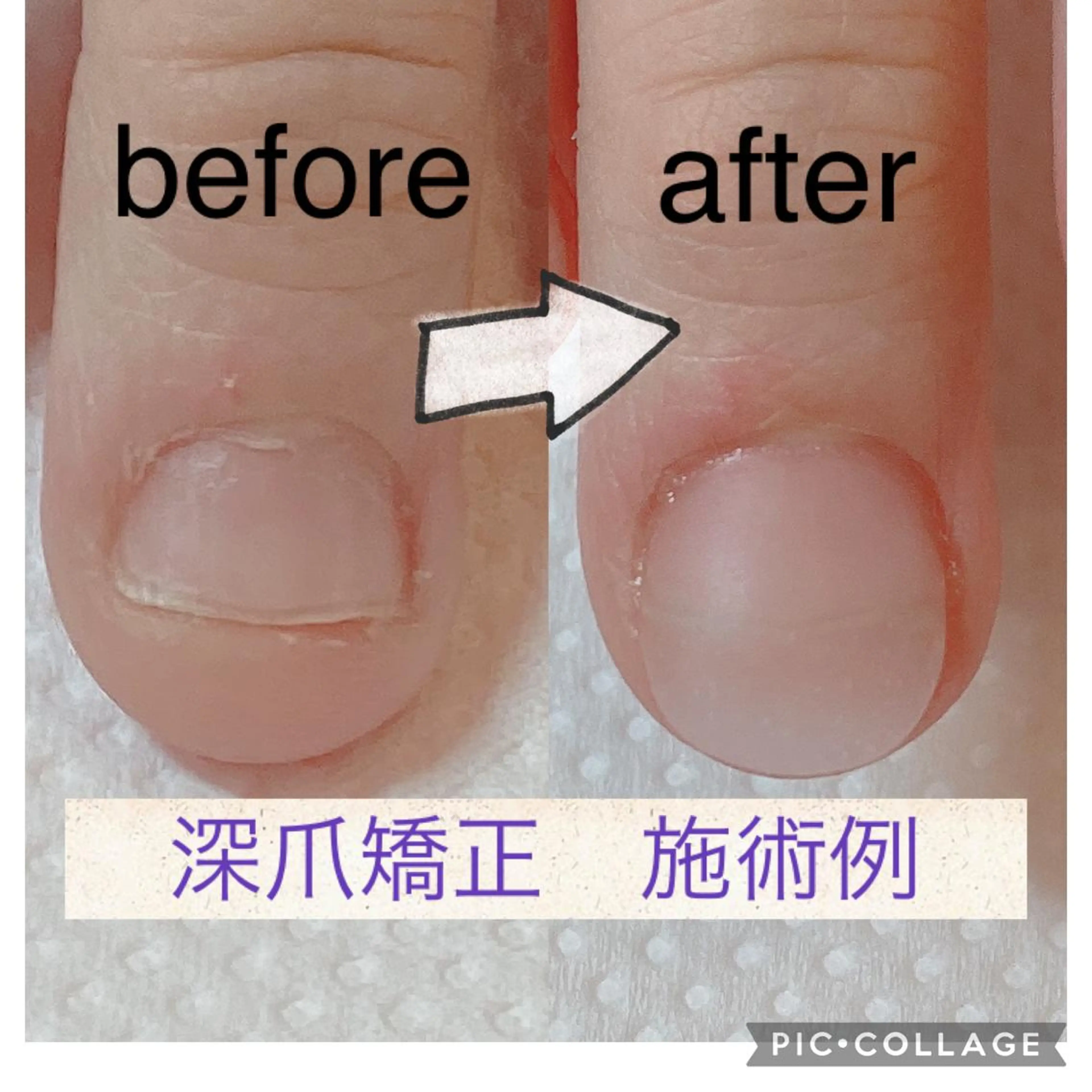 ウォーターケア＋深爪矯正にも⭐︎アクリルスカルプチュアの写真