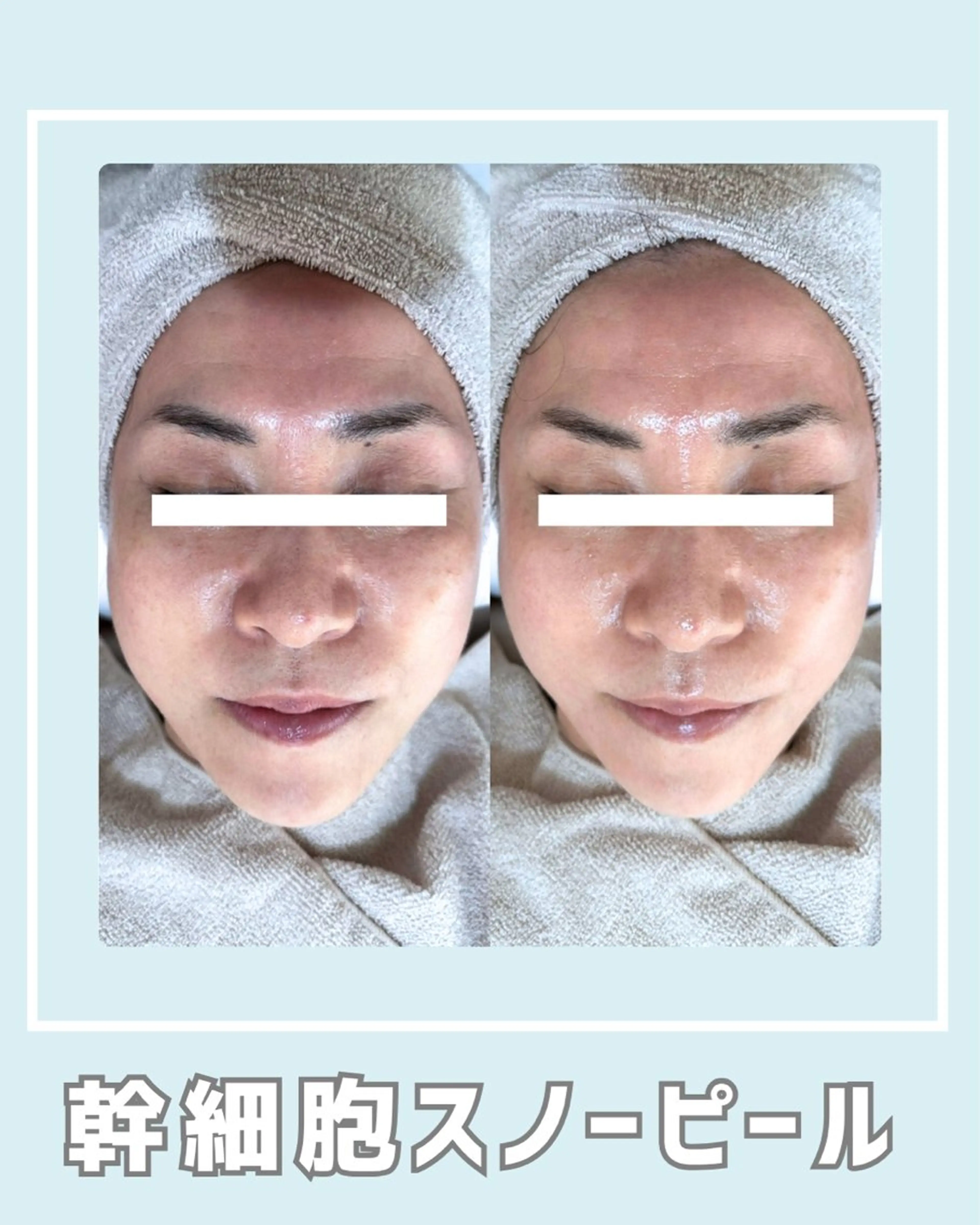 エステ |ピーリング・毛穴| soina神楽坂のエステ・リラクイメージ