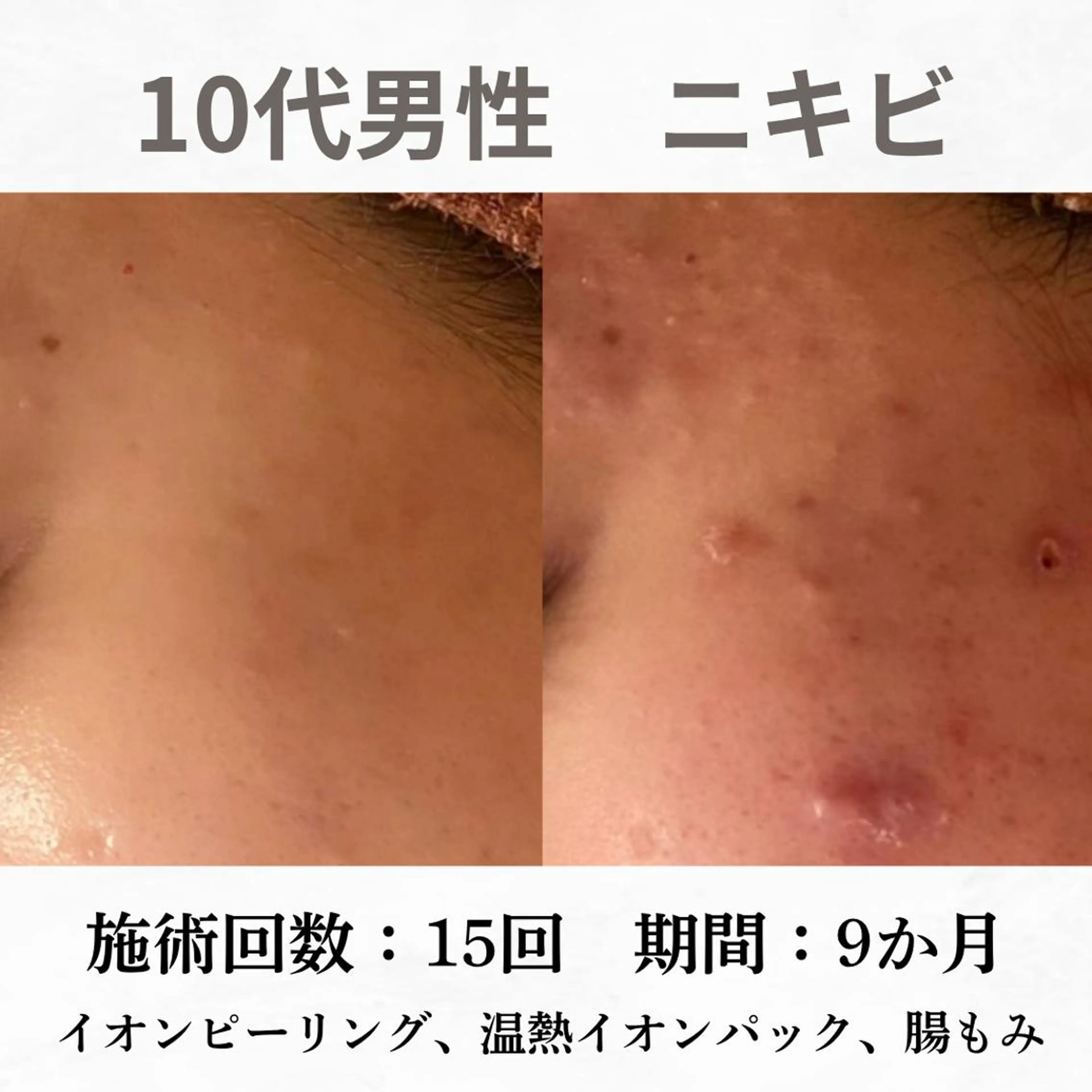 重度ニキビ専門🌷 ダウンタイムなしのエステ・リラクイメージ