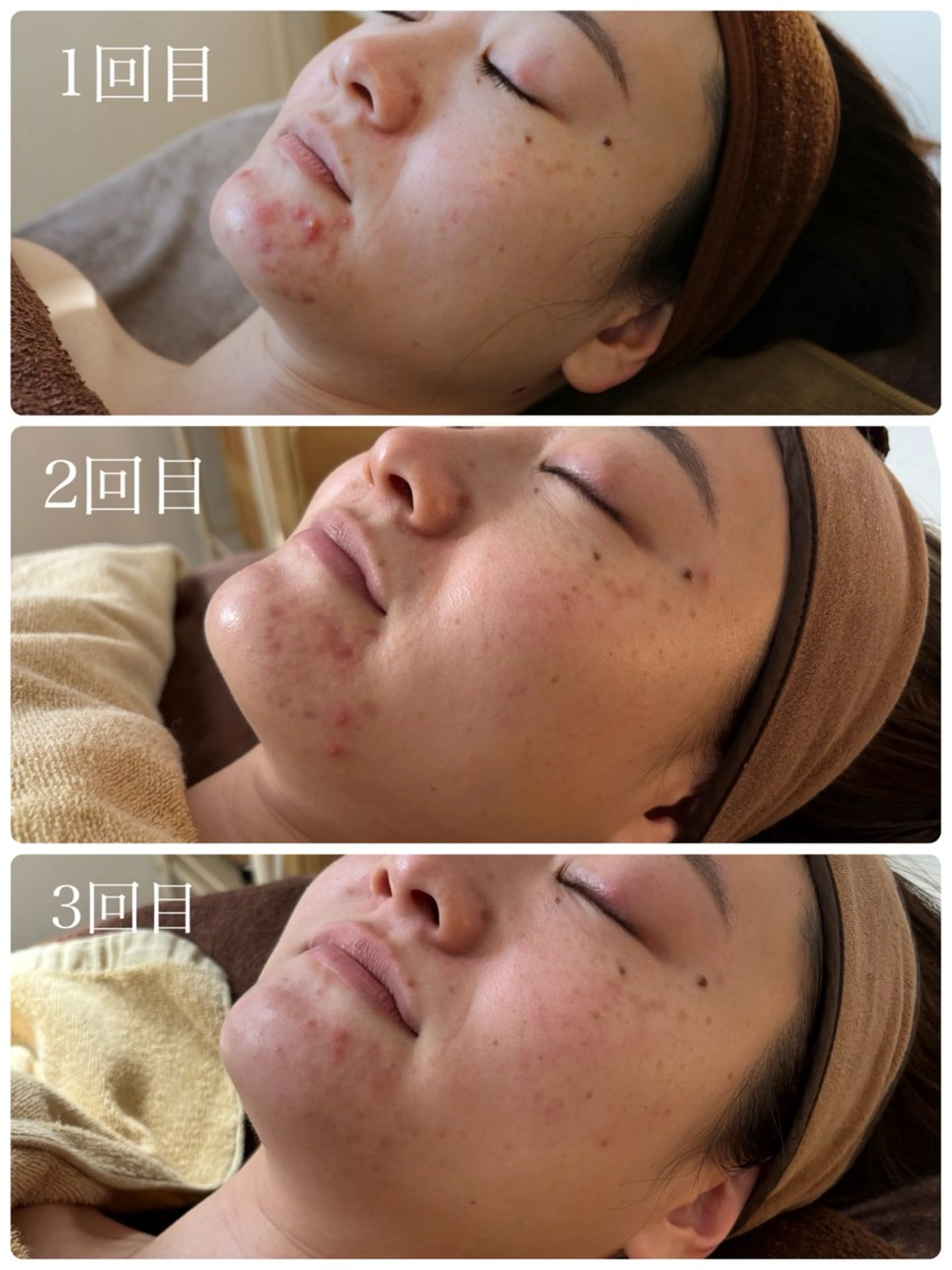 ハーブピーリング🌿 Vivaceのその他イメージ