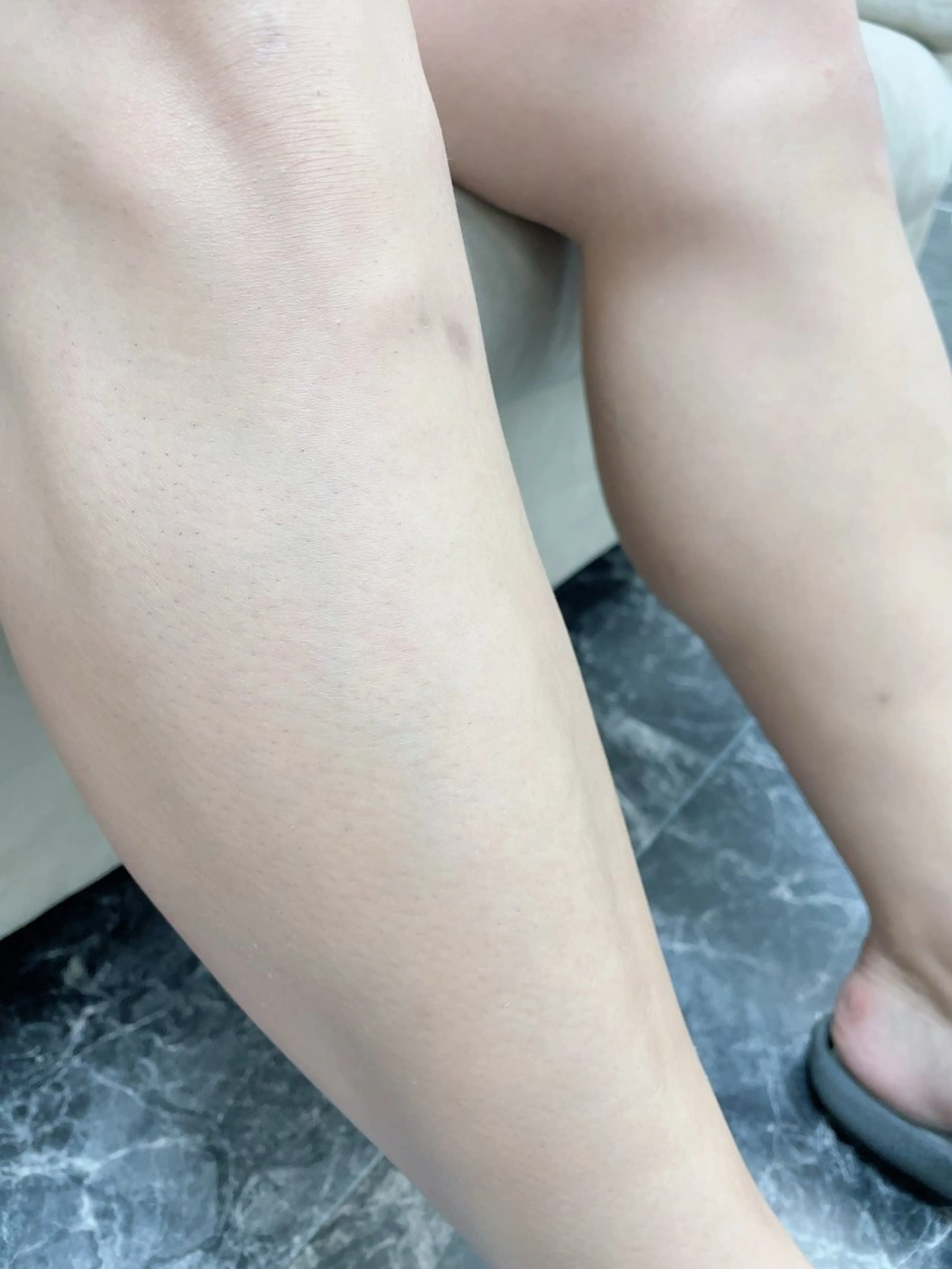 🧖🏻男性全身脱毛/フェイス.VIO込み/５回セット¥44,000/水・金・土限定/の写真