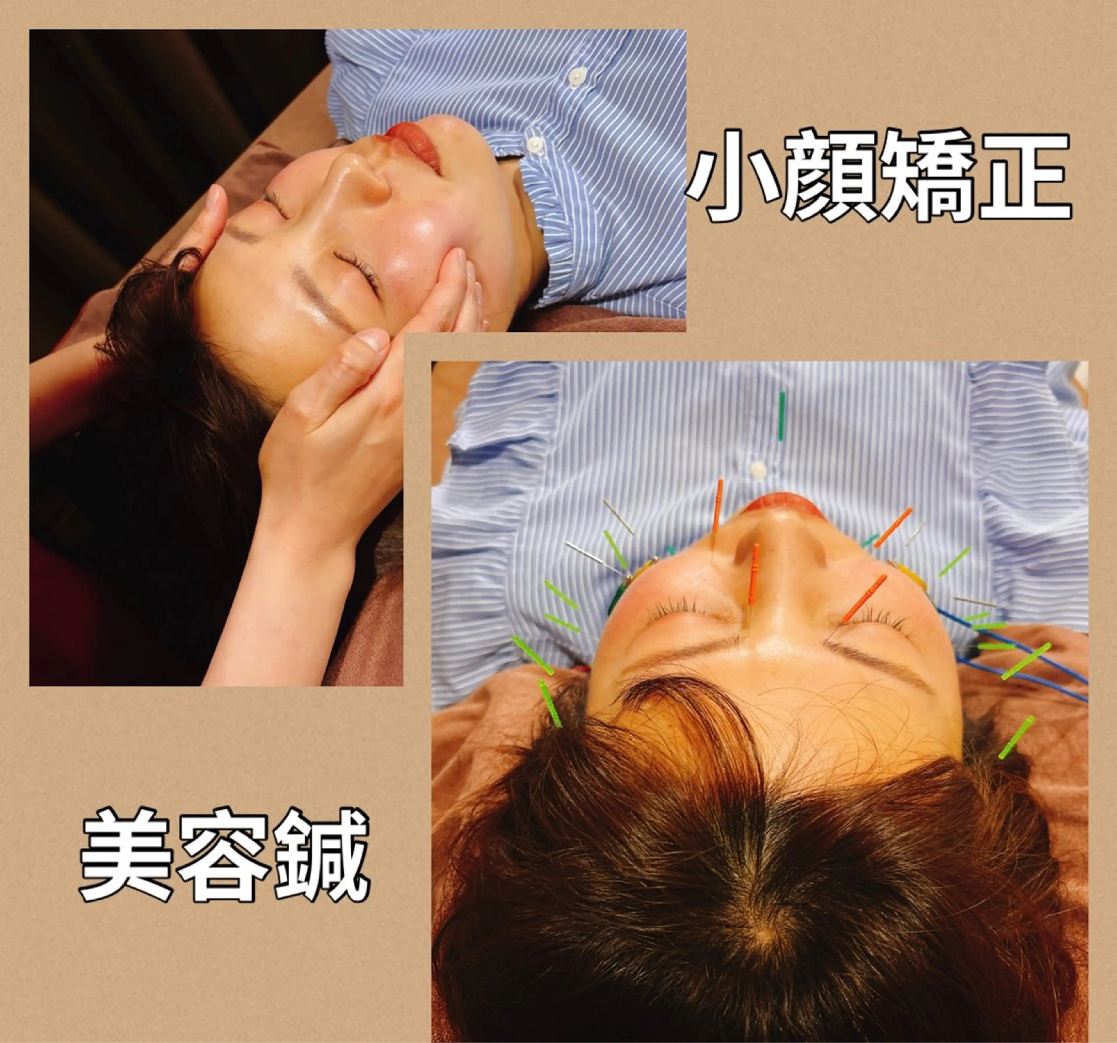°ʚ🎀即効性バツグン🎀ɞ°.美容鍼➕小顔矯正➕首、肩マッサージ✨の写真