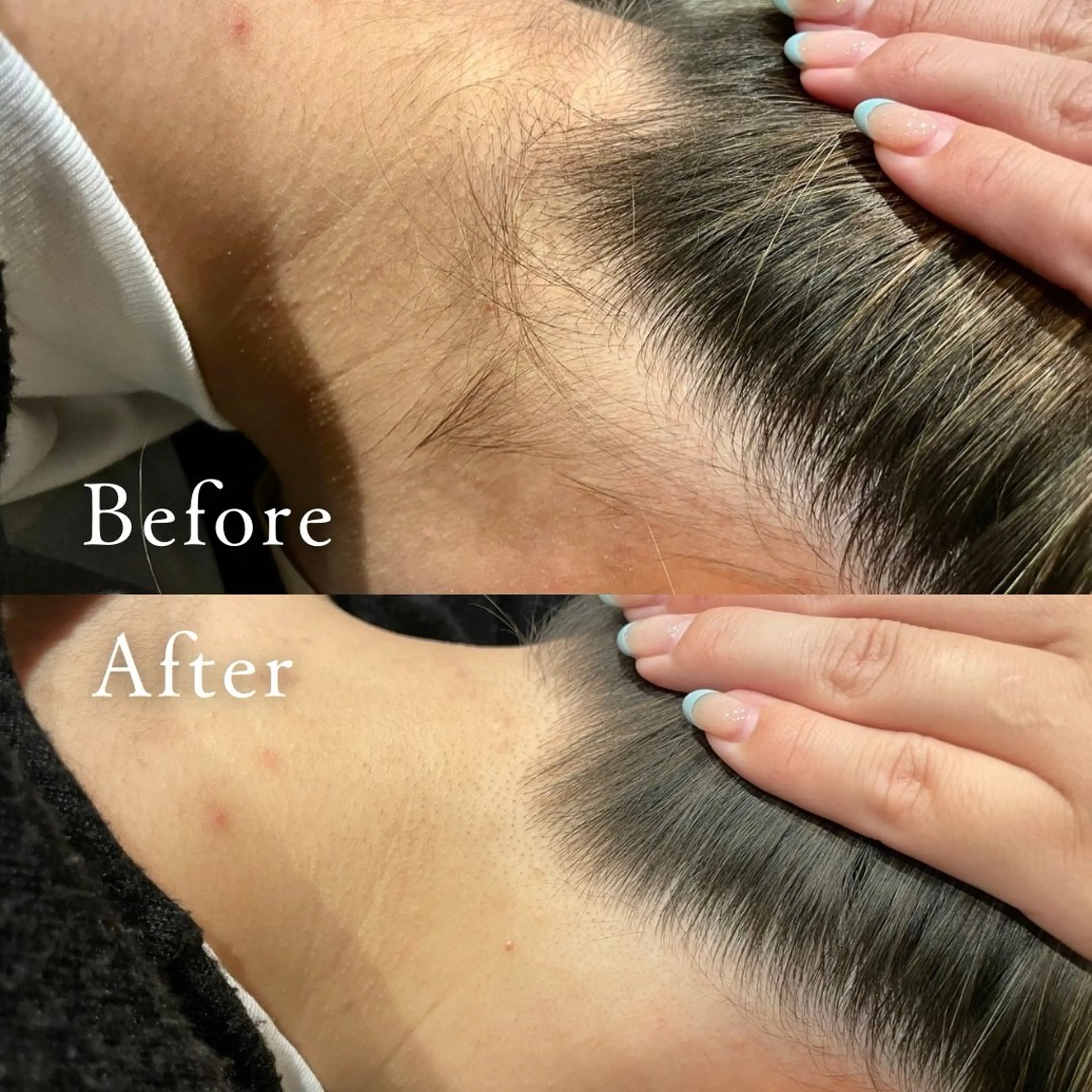 全身脱毛の写真