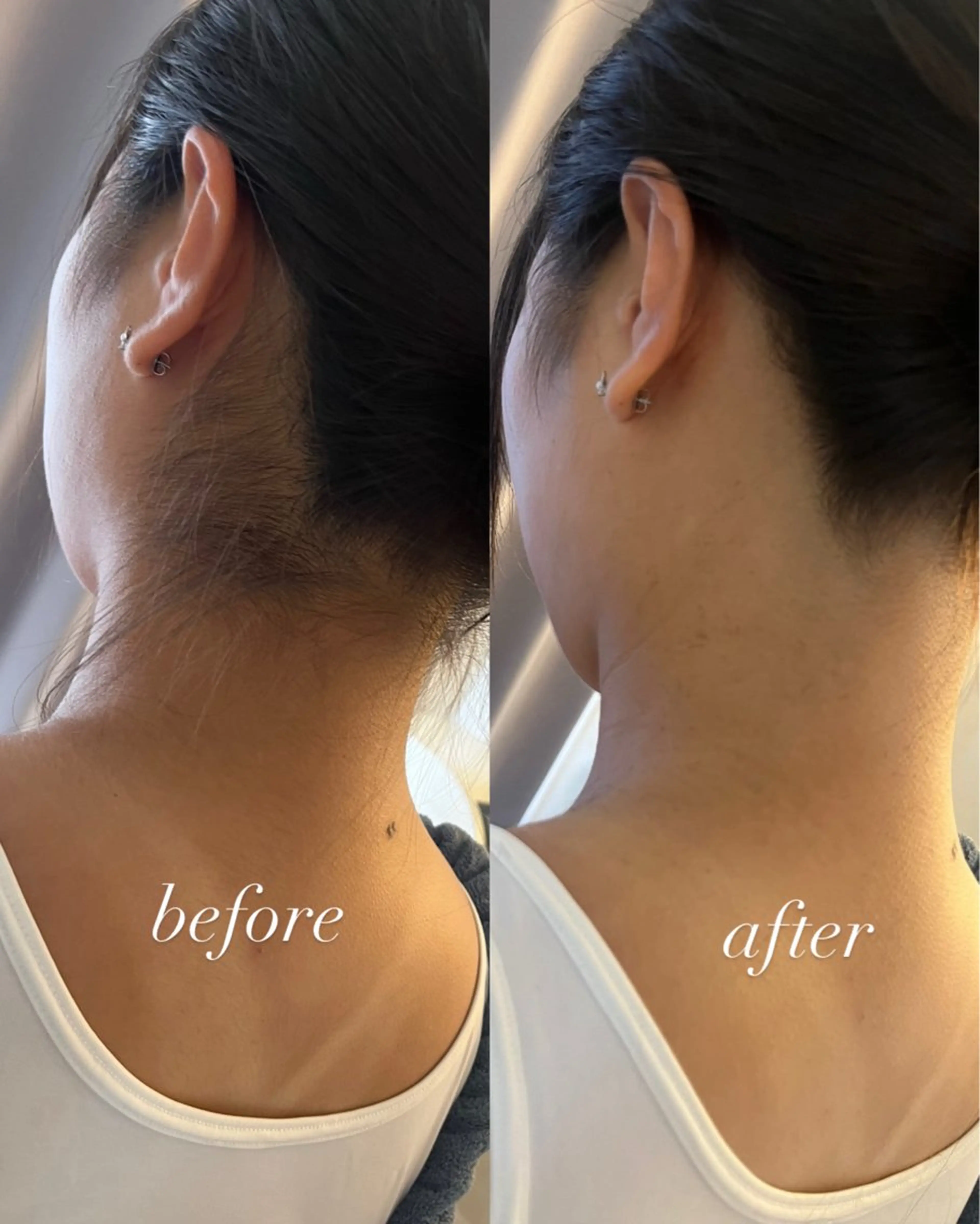 脱毛 うなじ脱毛/美肌脱毛 LABELのエステ・リラクイメージ