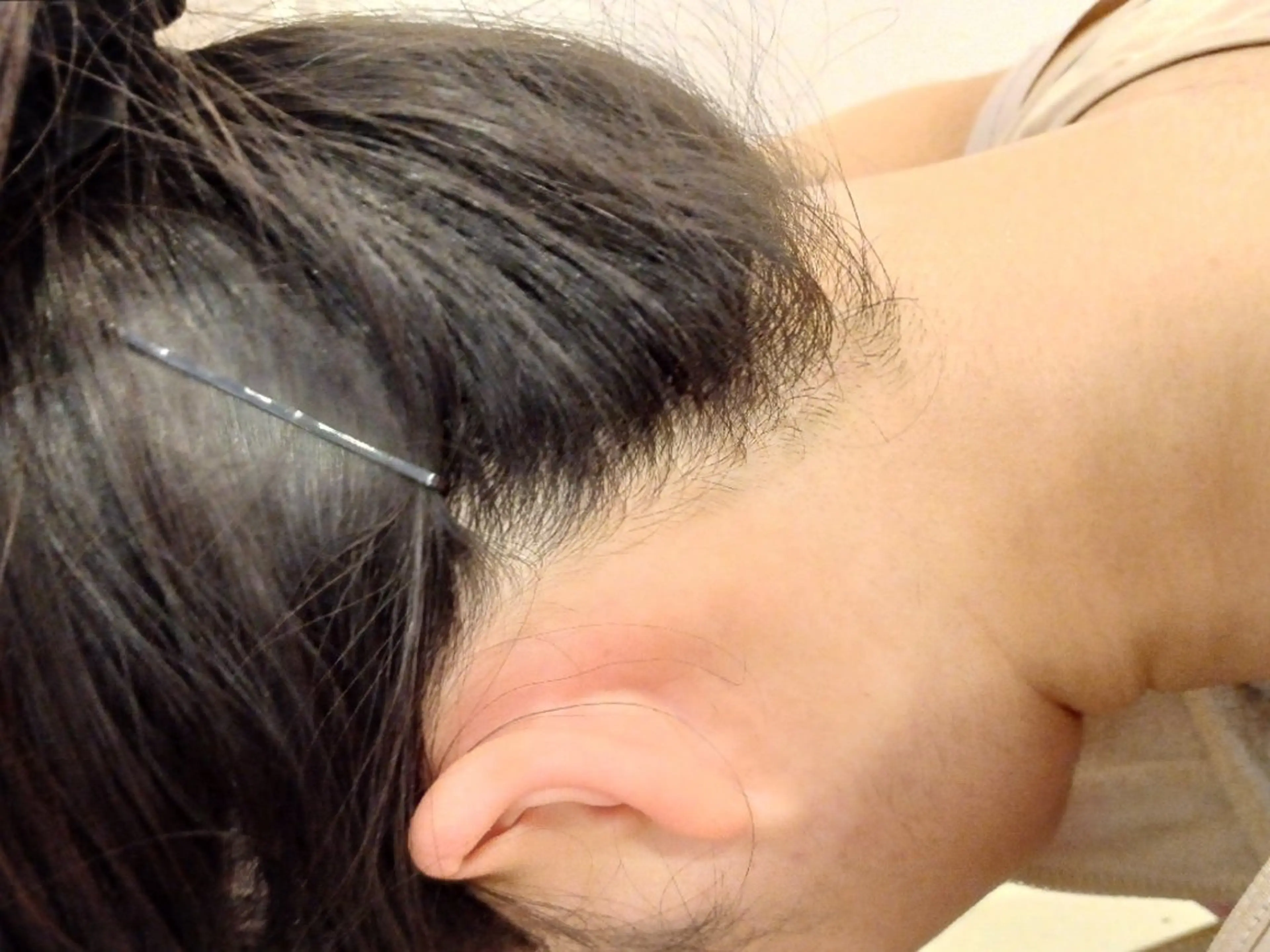 うなじ脱毛2回セットの写真