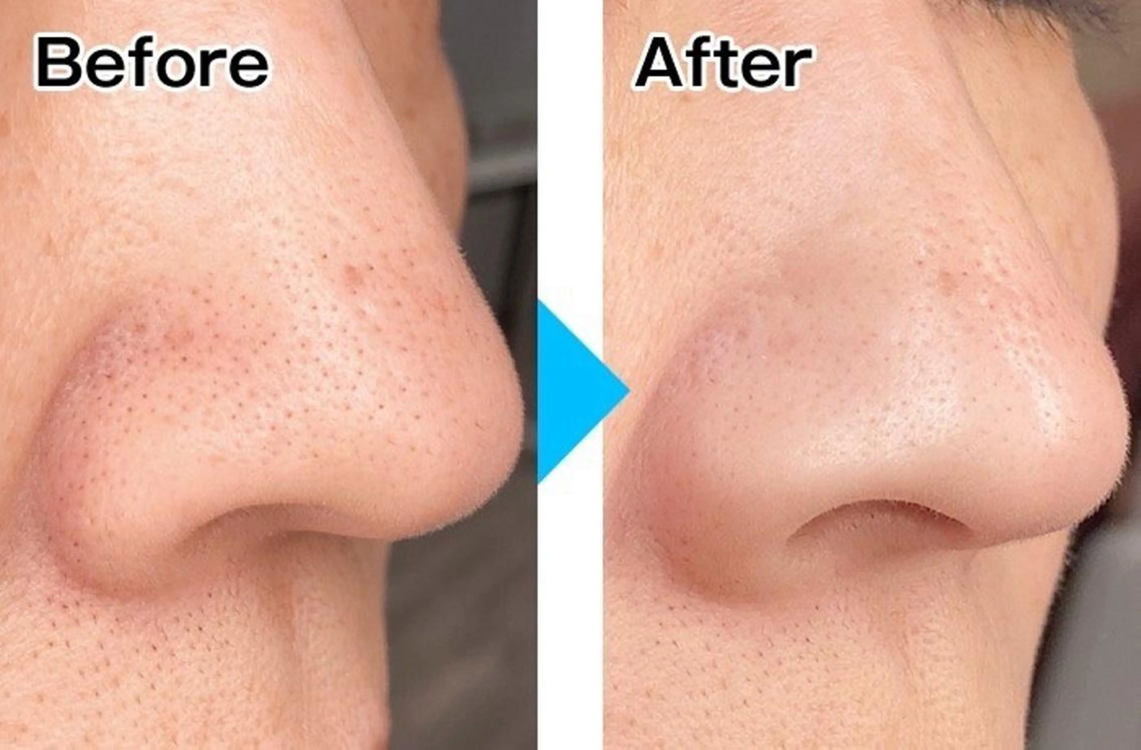 【💆‍♀️スペシャル毛穴💆‍♀️】《ミニモ限定価格‼️》話題のハイドロ洗浄！水素で古い角質を取って毛穴０肌に♪の写真