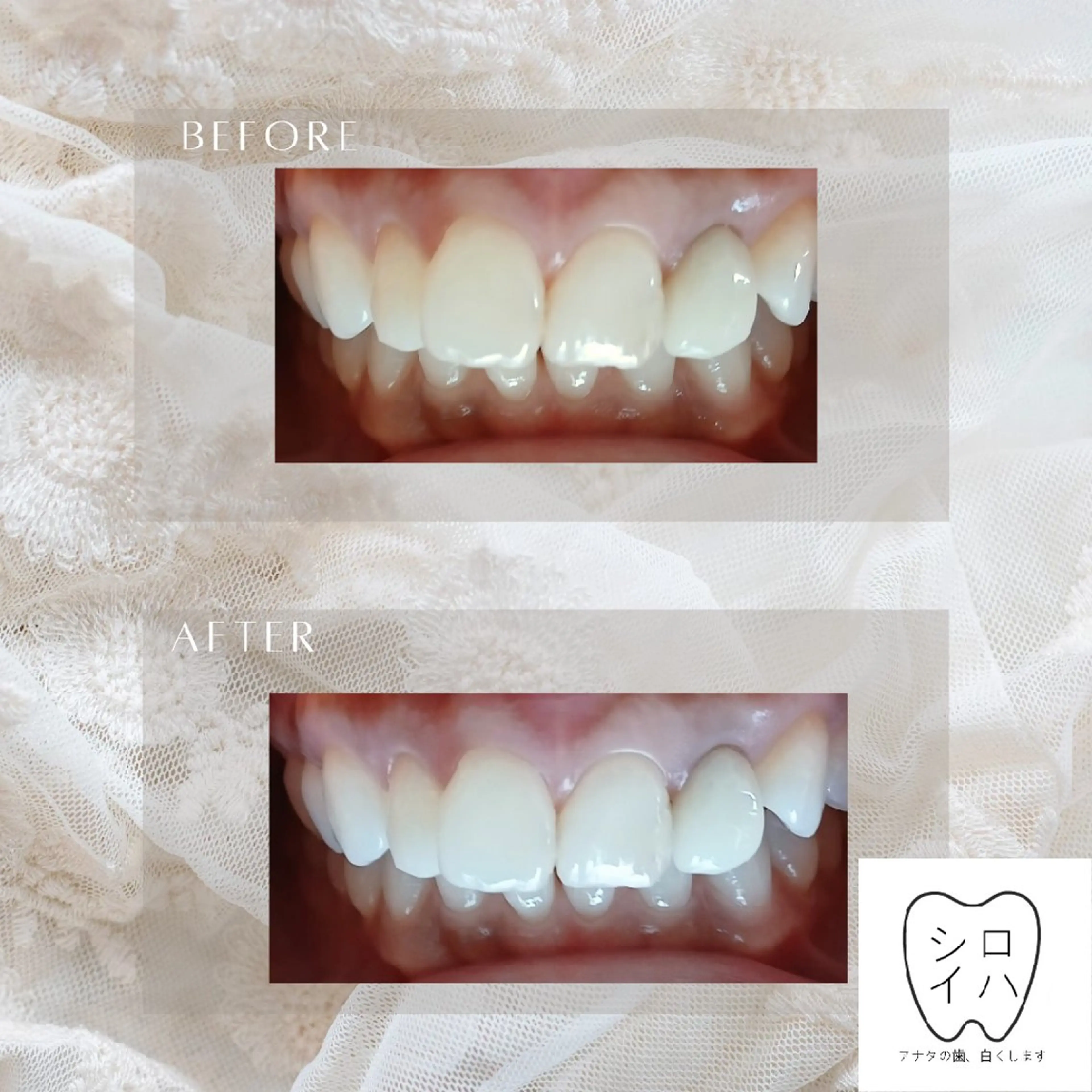 ホワイトニングサロン シロイハ所属・歯を白くしたい方🦷 シロイハのその他イメージ