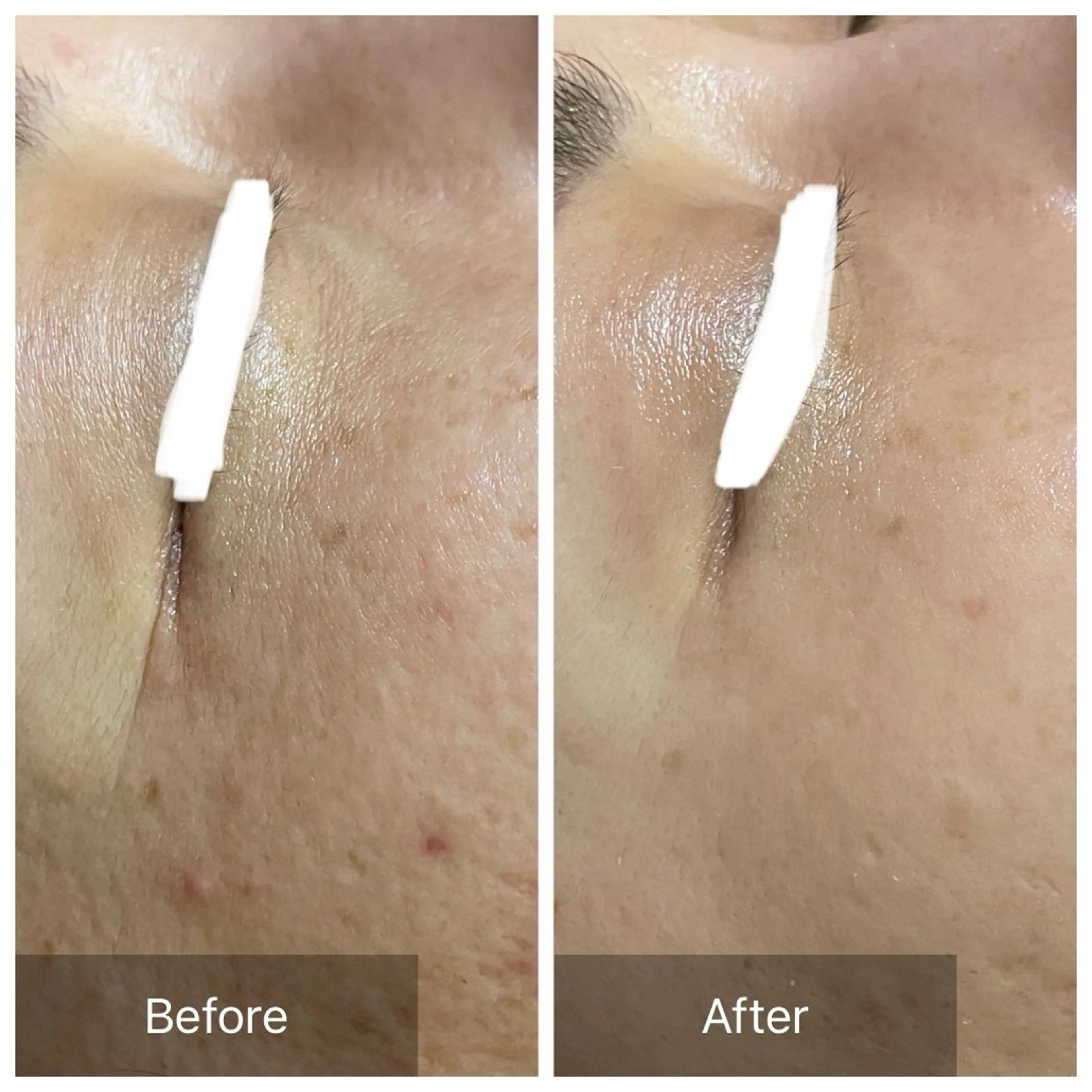 【特に目元が気になる方】ハーブピーリング🌿.∘の写真