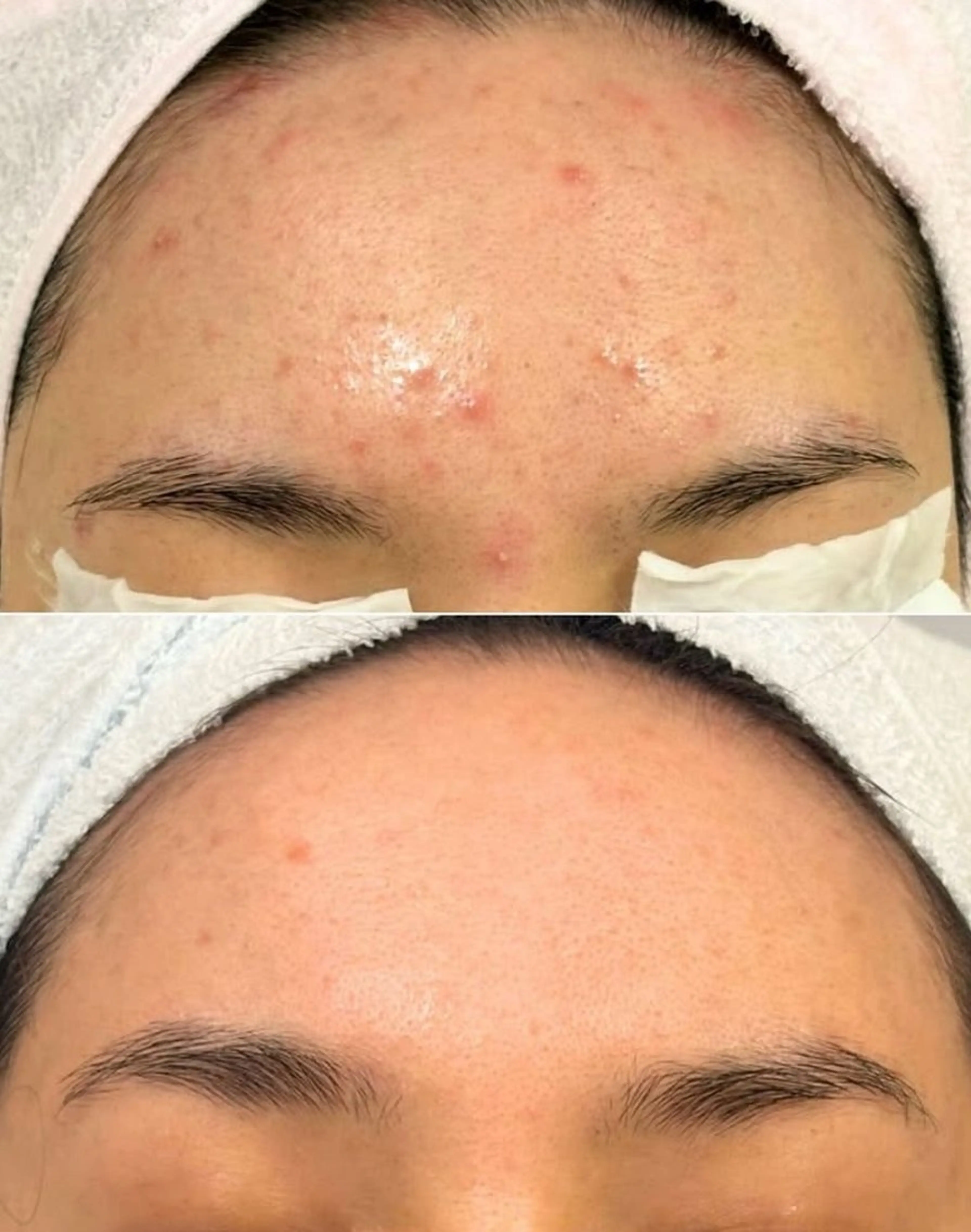 ハーブピーリング 男性の写真