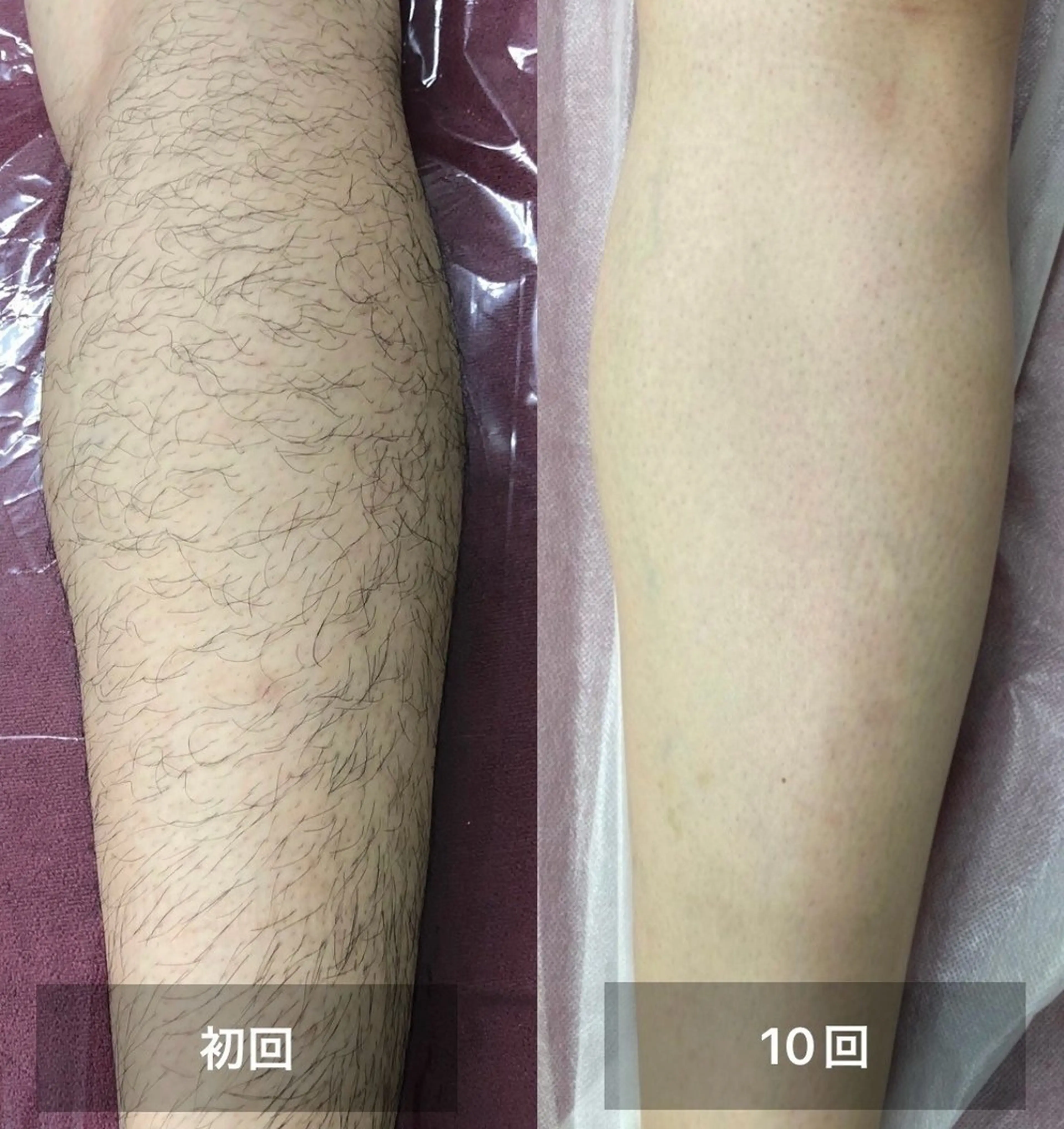 全身脱毛​〜​男性の写真