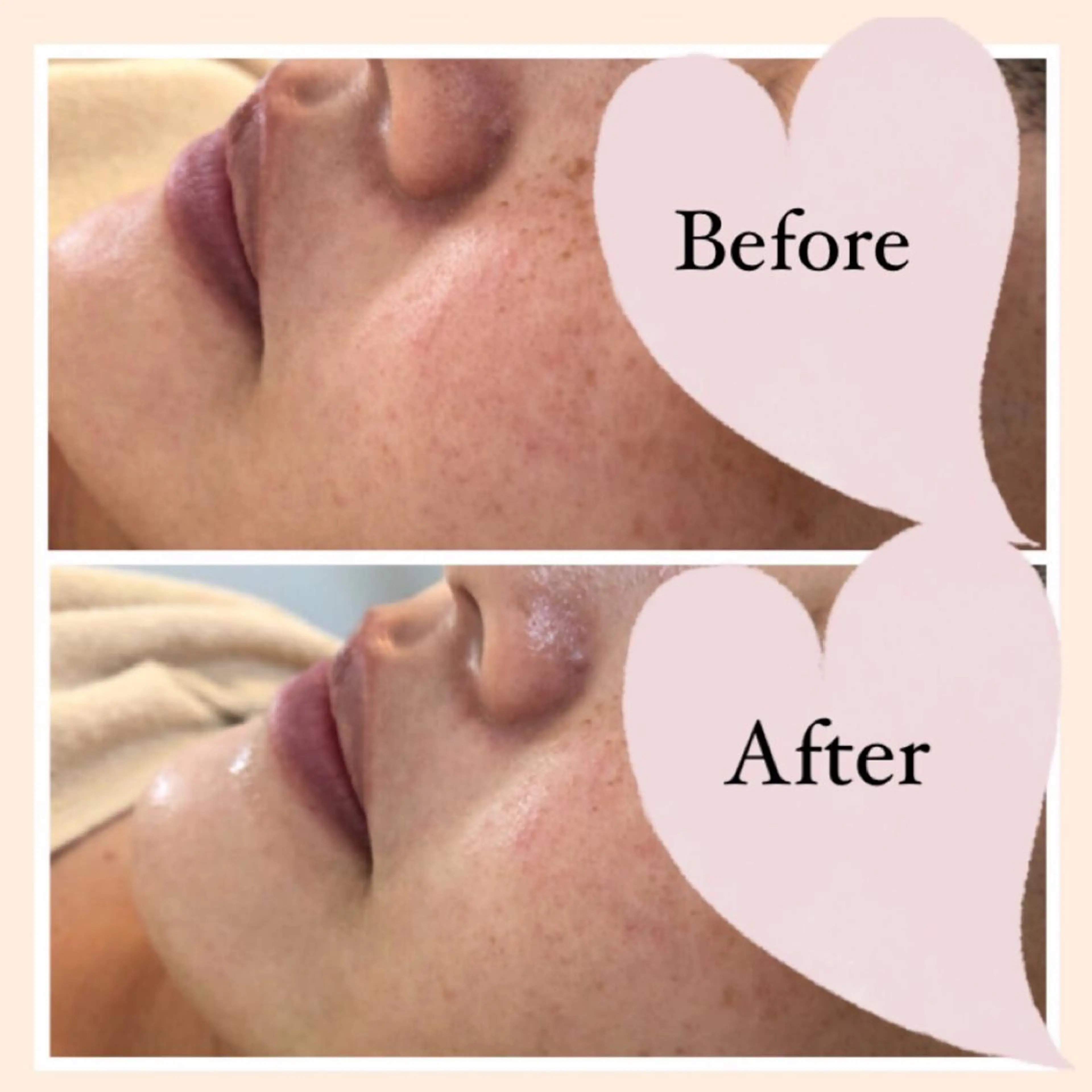 エステ ニキビ/敏感肌/乾燥 Lilyauraのエステ・リラクイメージ