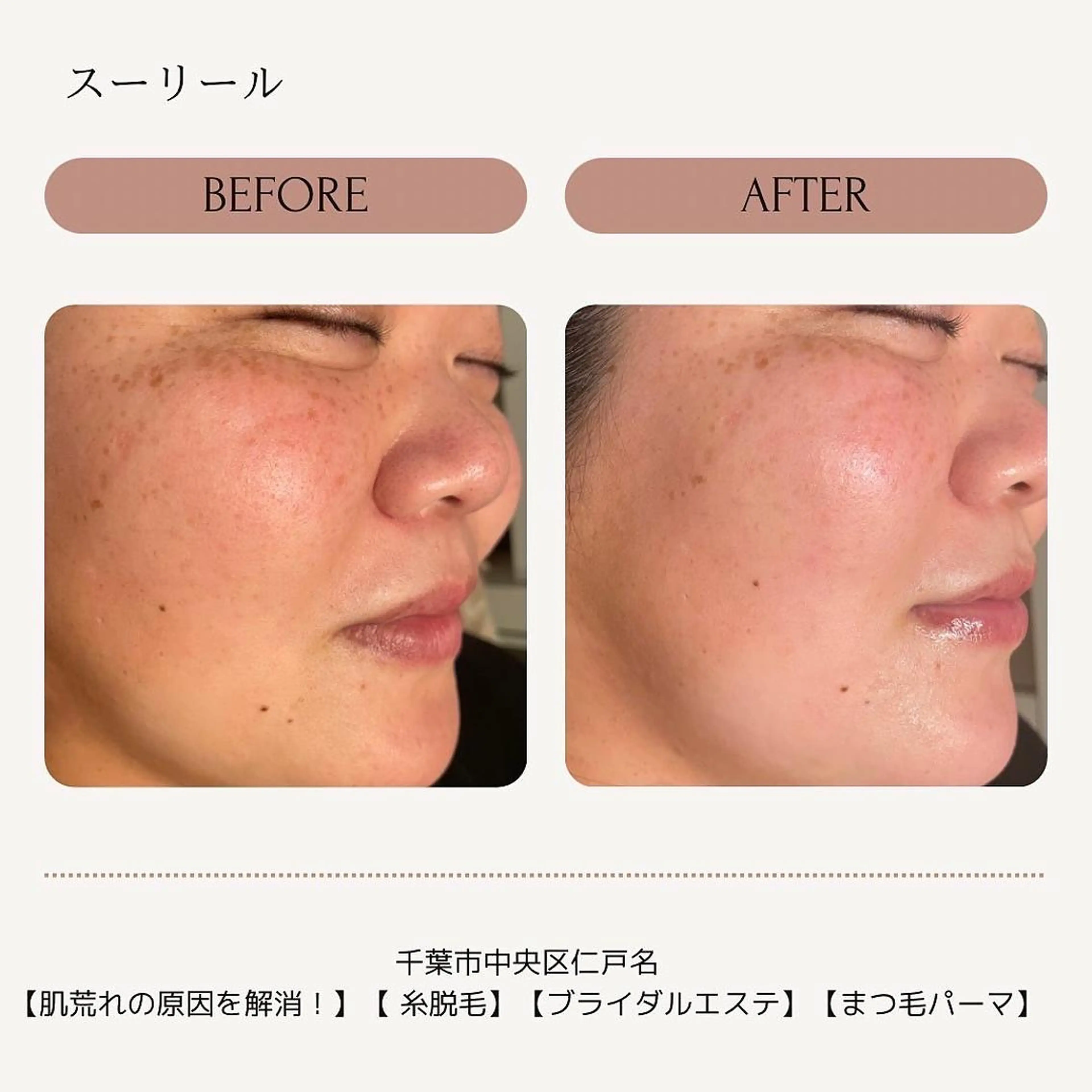 エステ 肌荒れに悩む方のため オイルフリーサロンのマツエク・マツパデザイン