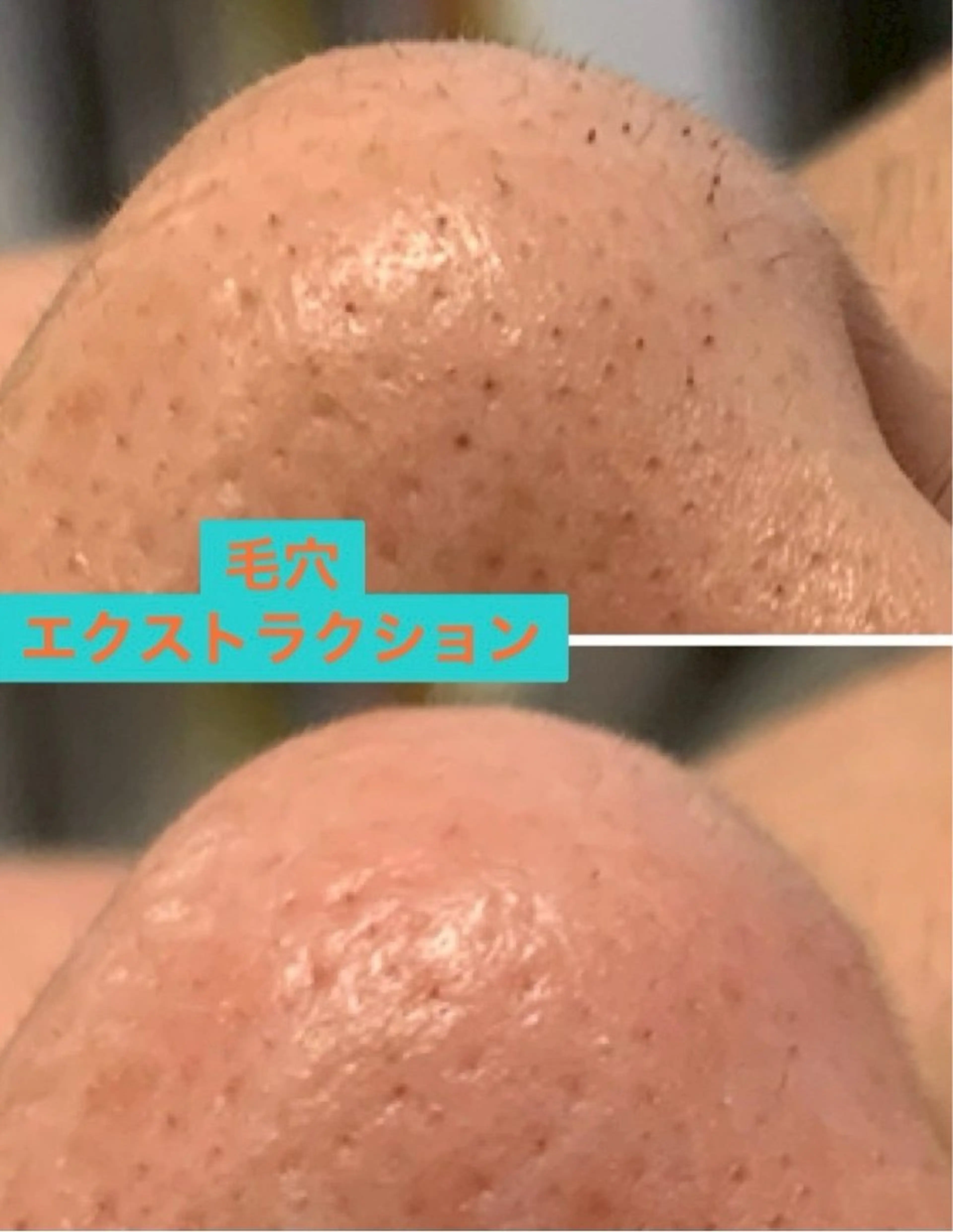 ✨毛穴洗浄✨　　　　　　　　　　　　　　　　　　　tete式毛穴エクストラクションの写真