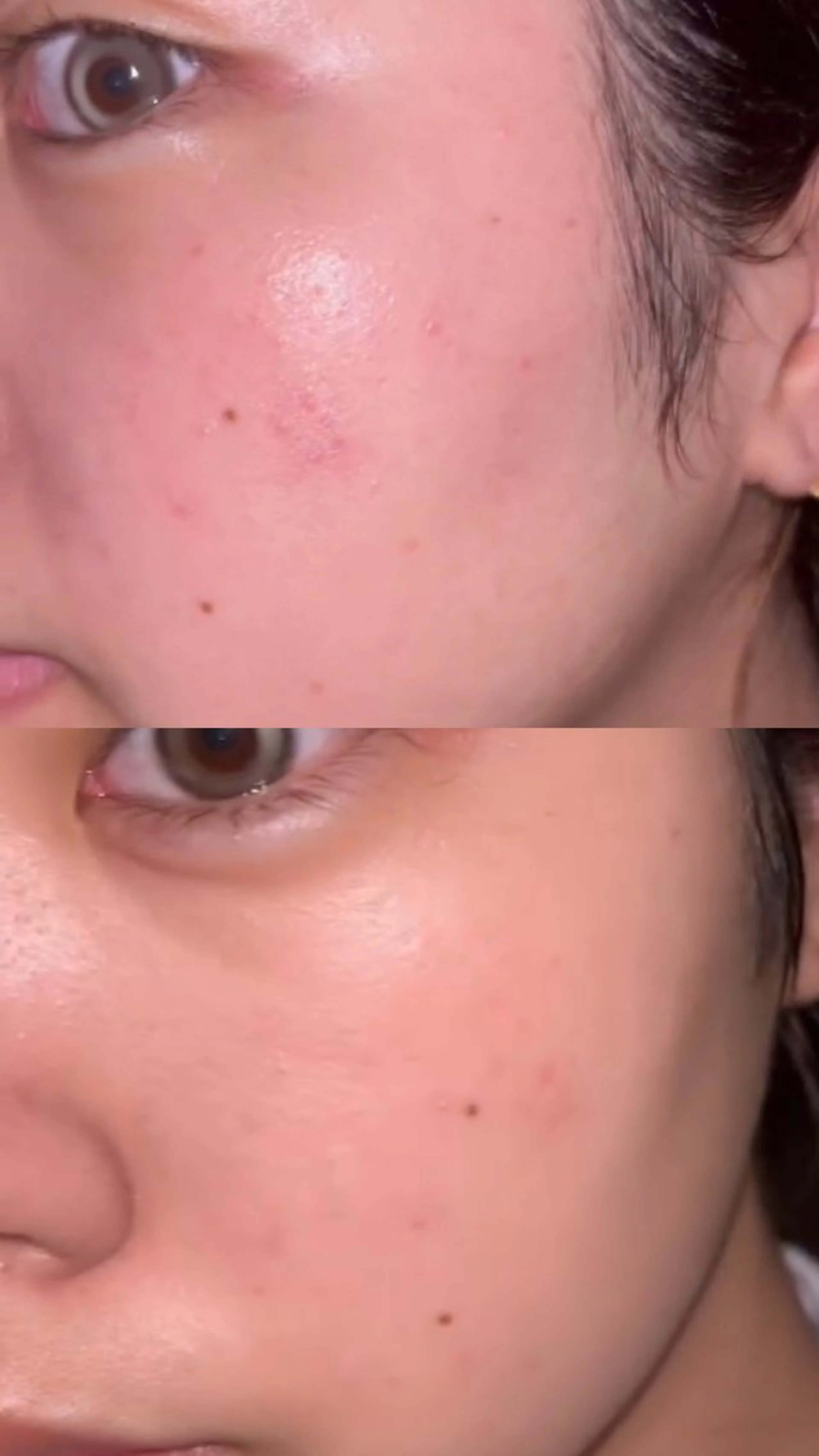 【ニキビ撃退】REVIハーブピーリング集中ケアの写真