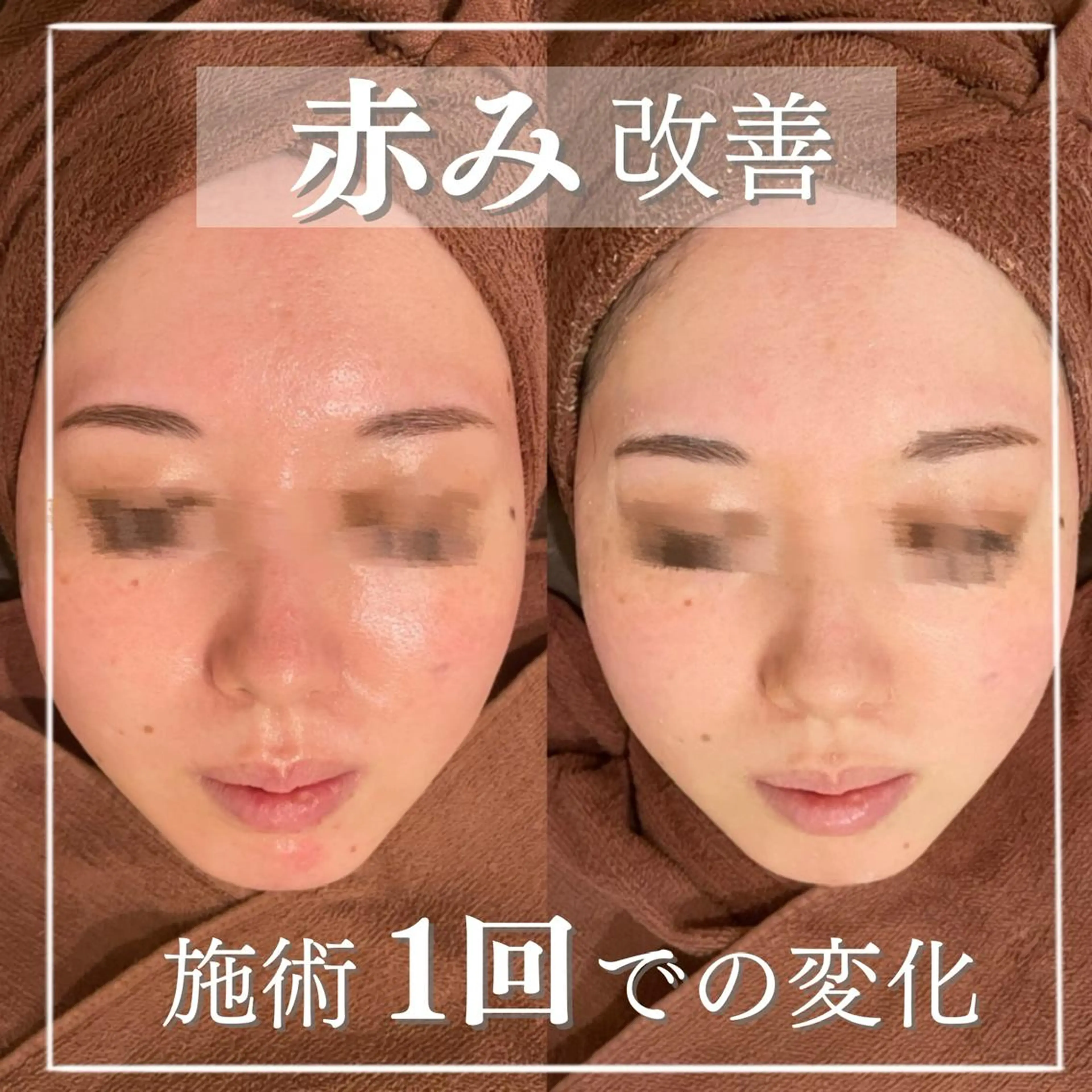 セミロング カラー パーマ ヘアアレンジ メンズ キッズ ネイル マツエク・マツパ アイブロウ ニキビ特化型エステ 🍓最短で肌質改善のエステ・リラクイメージ