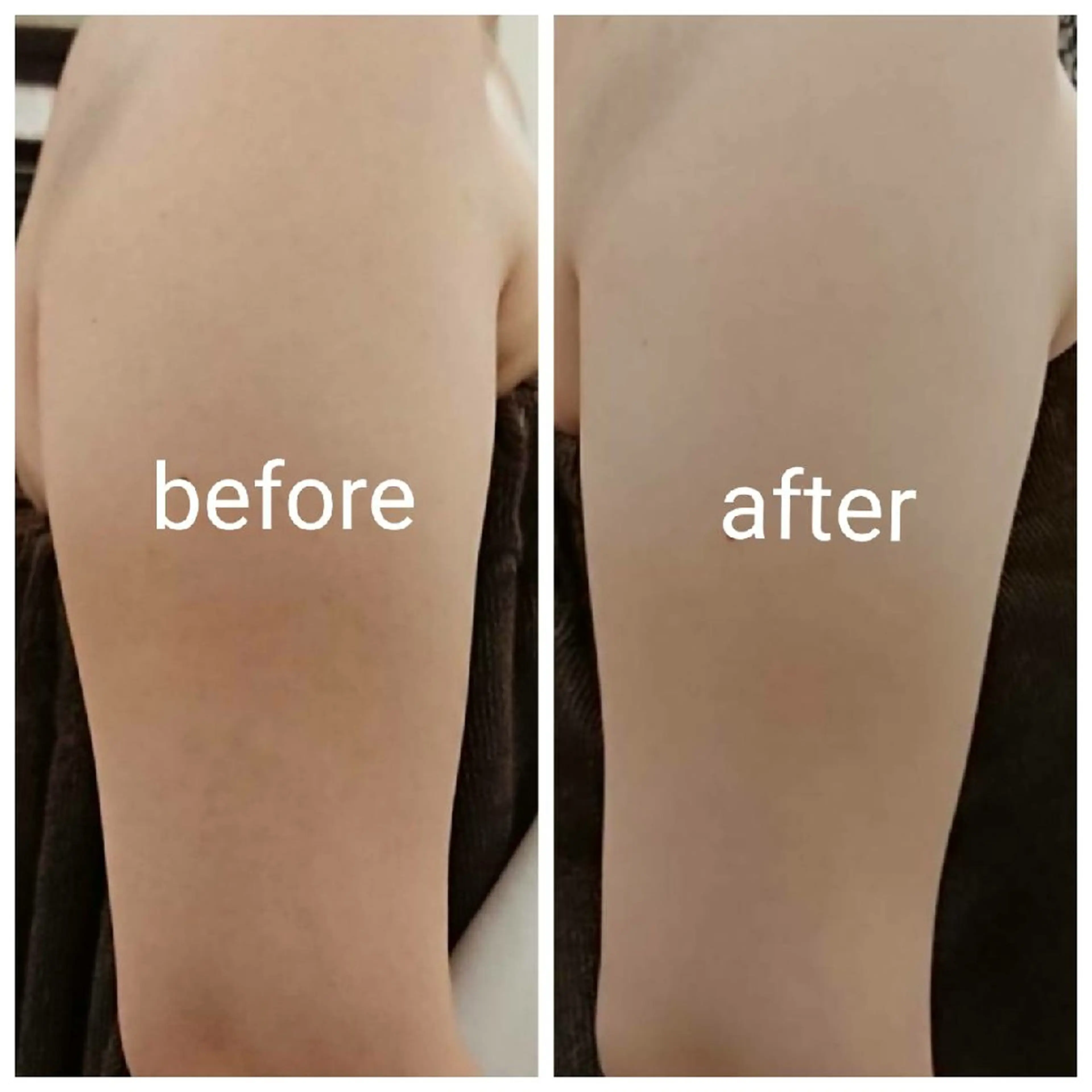 【酵素美容* ポツポツ二の腕ケア】 ざらつき✨日焼け✨ニキビ✨の写真