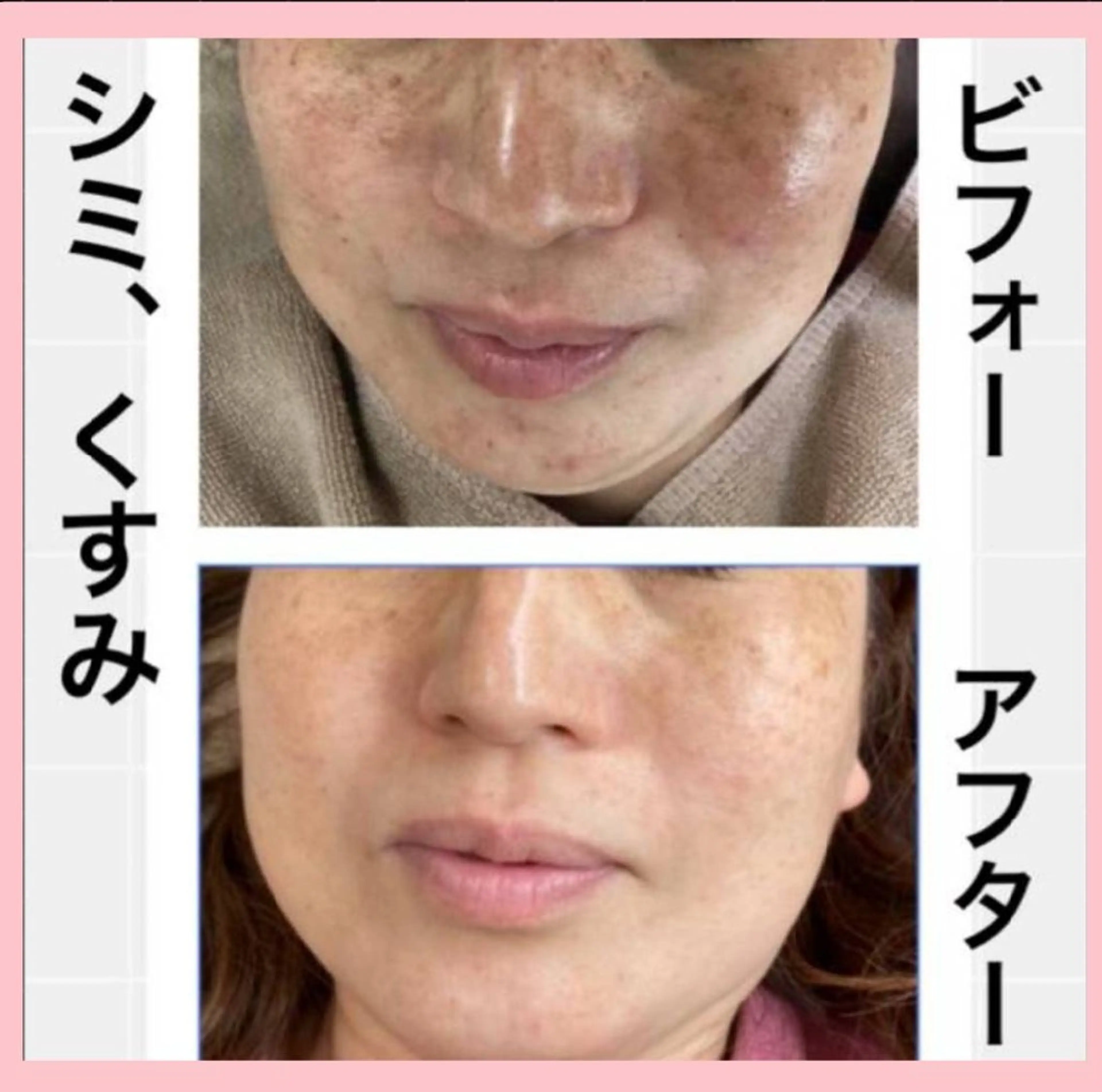 🌿ハーブピーリングハード&(毛穴洗浄、角質除去、美容保湿)🌿吹き出物、吹き出物跡、毛穴、美白、黒ずみ、肌質ケアにの写真