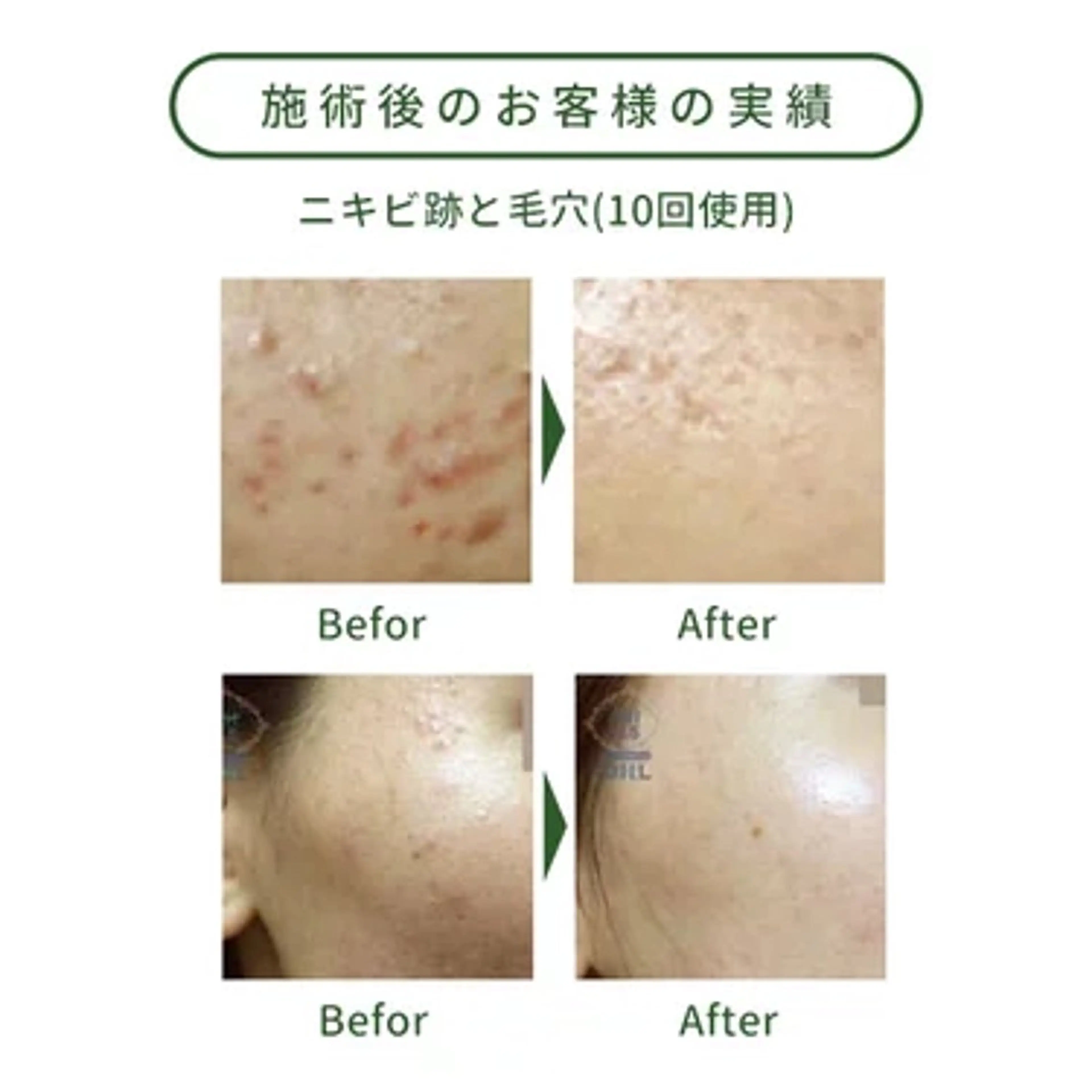 フェイシャルトリートメント（植物由来パウダーケア）の写真