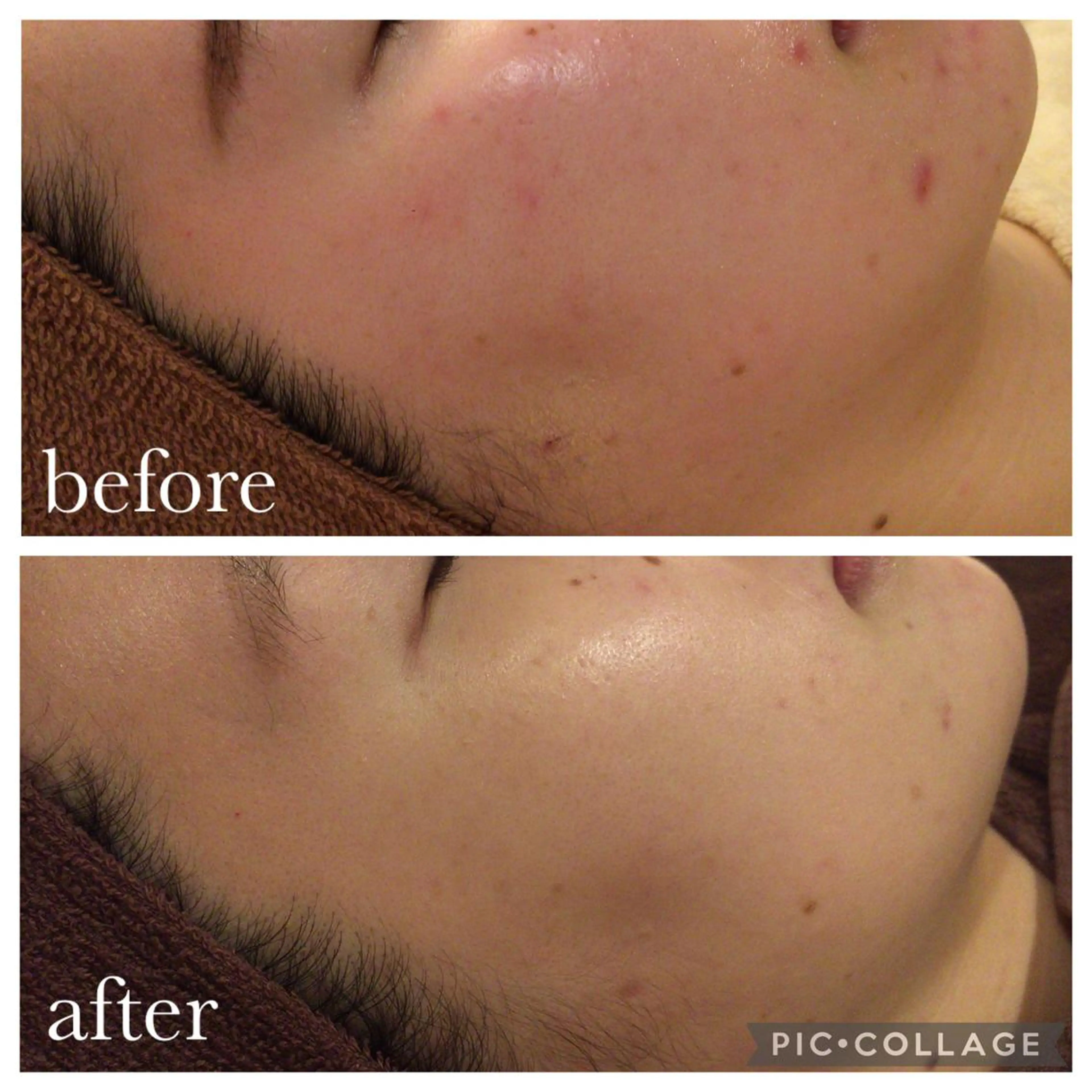 都内で出来る肌管理！ 最短ニキビ改善のエステ・リラクイメージ