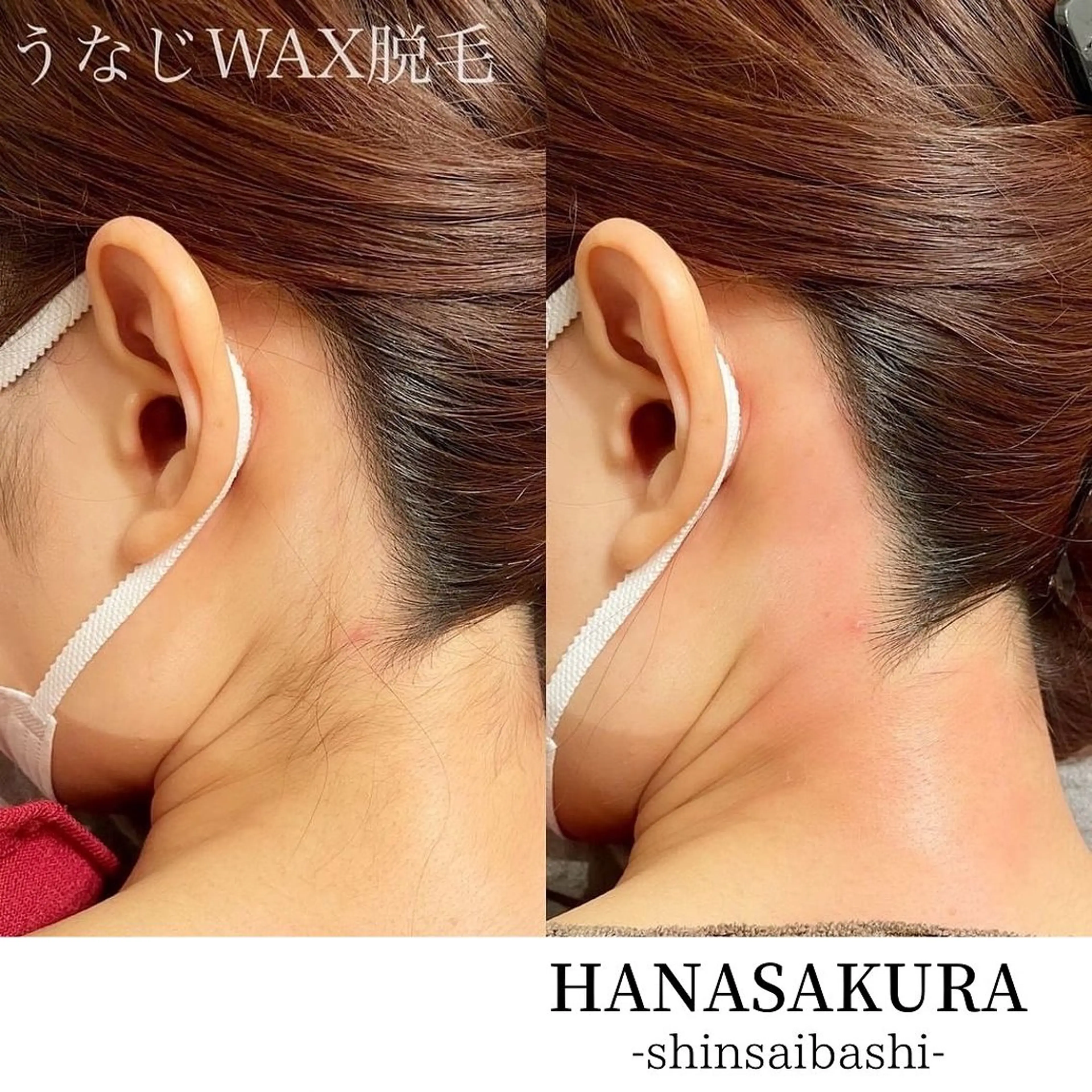 【ミニモ特価】うなじワックス脱毛の写真