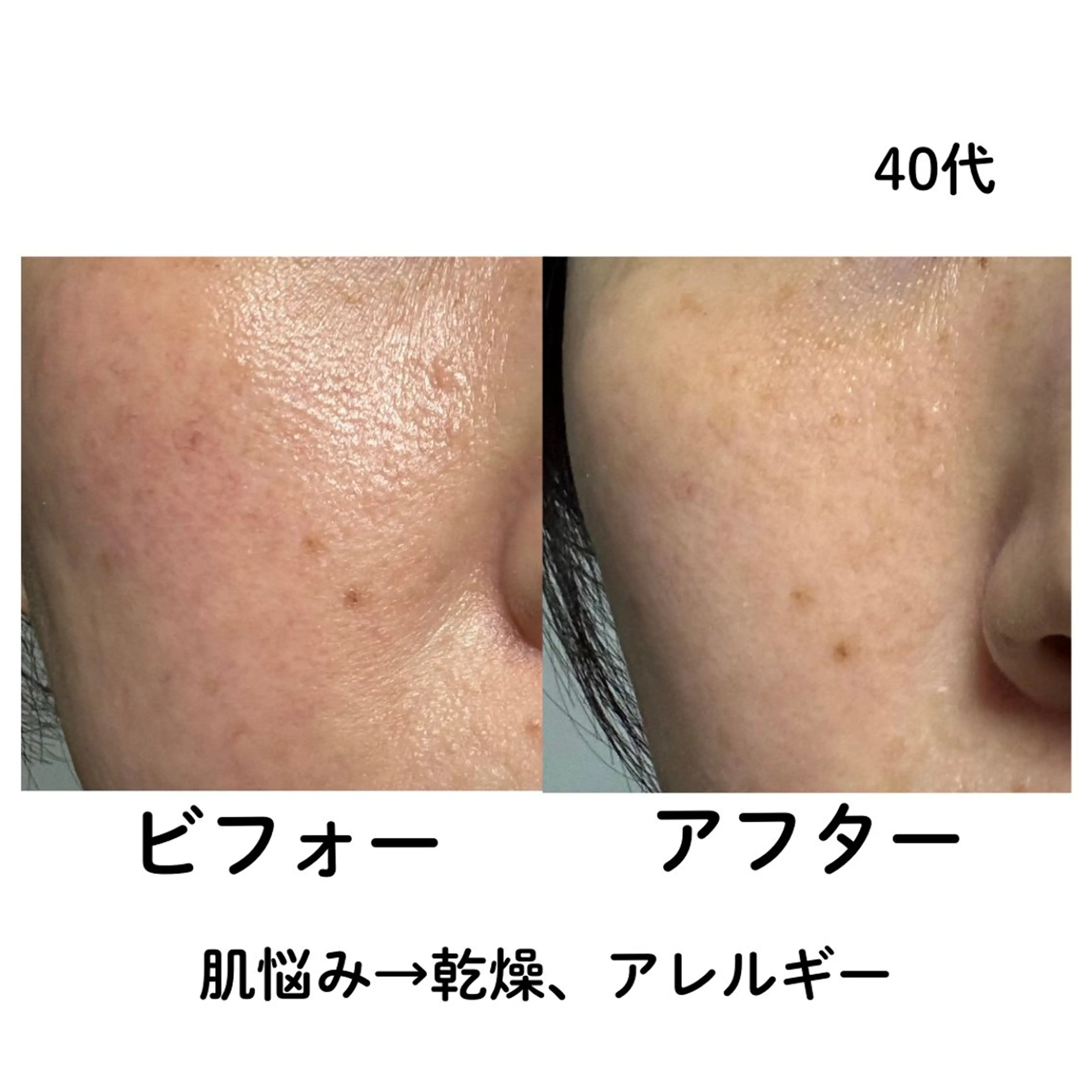 【エステ初心者にオススメ】うるおいチャージ＆美肌菌フェイシャル（６０分）の写真