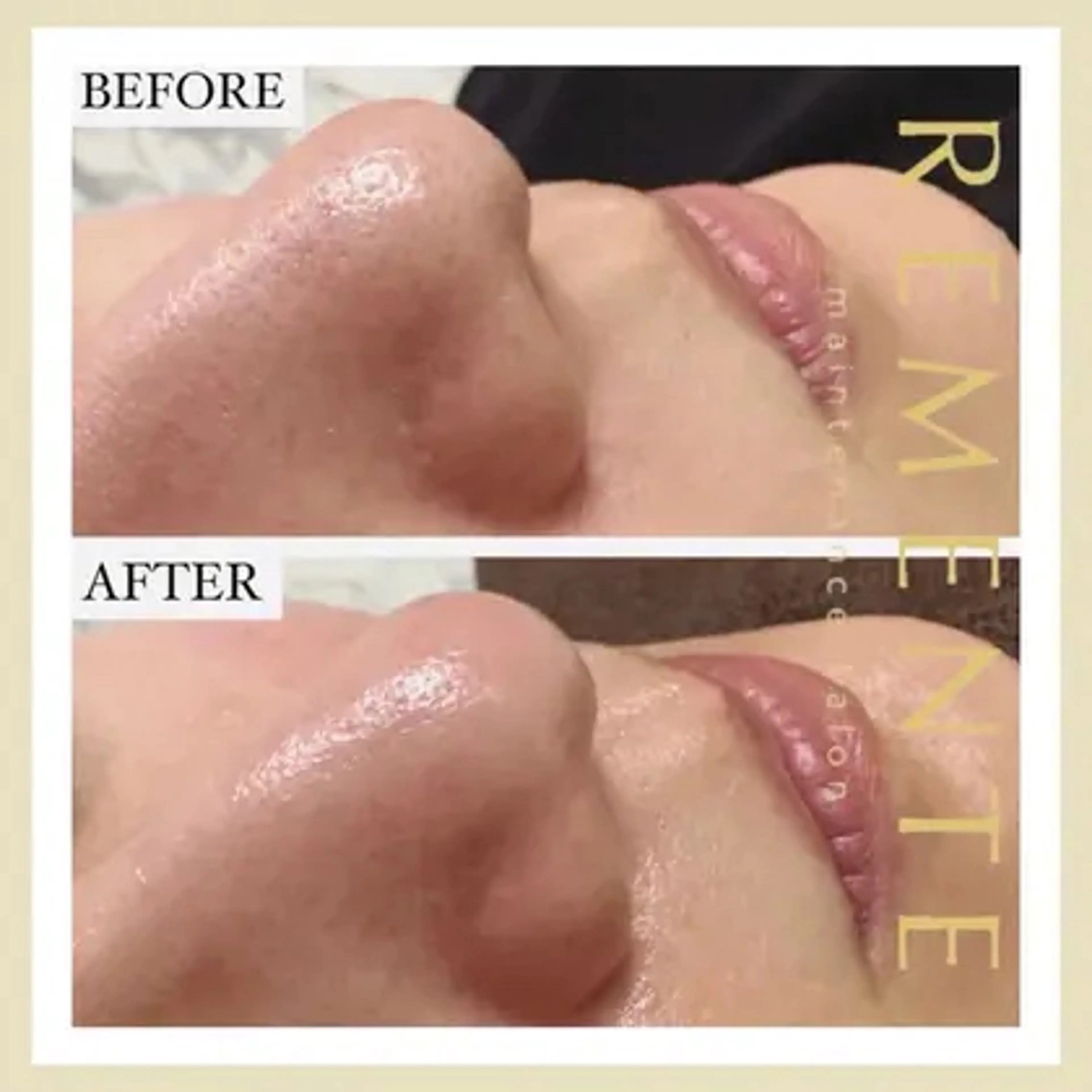 【✨口コミ記載の方体験半額!✨】★期間限定★毛穴の汚れを一掃✨ハイドラフェイシャル(毛穴洗浄)‼️ニキビや黒ずみに効果の写真