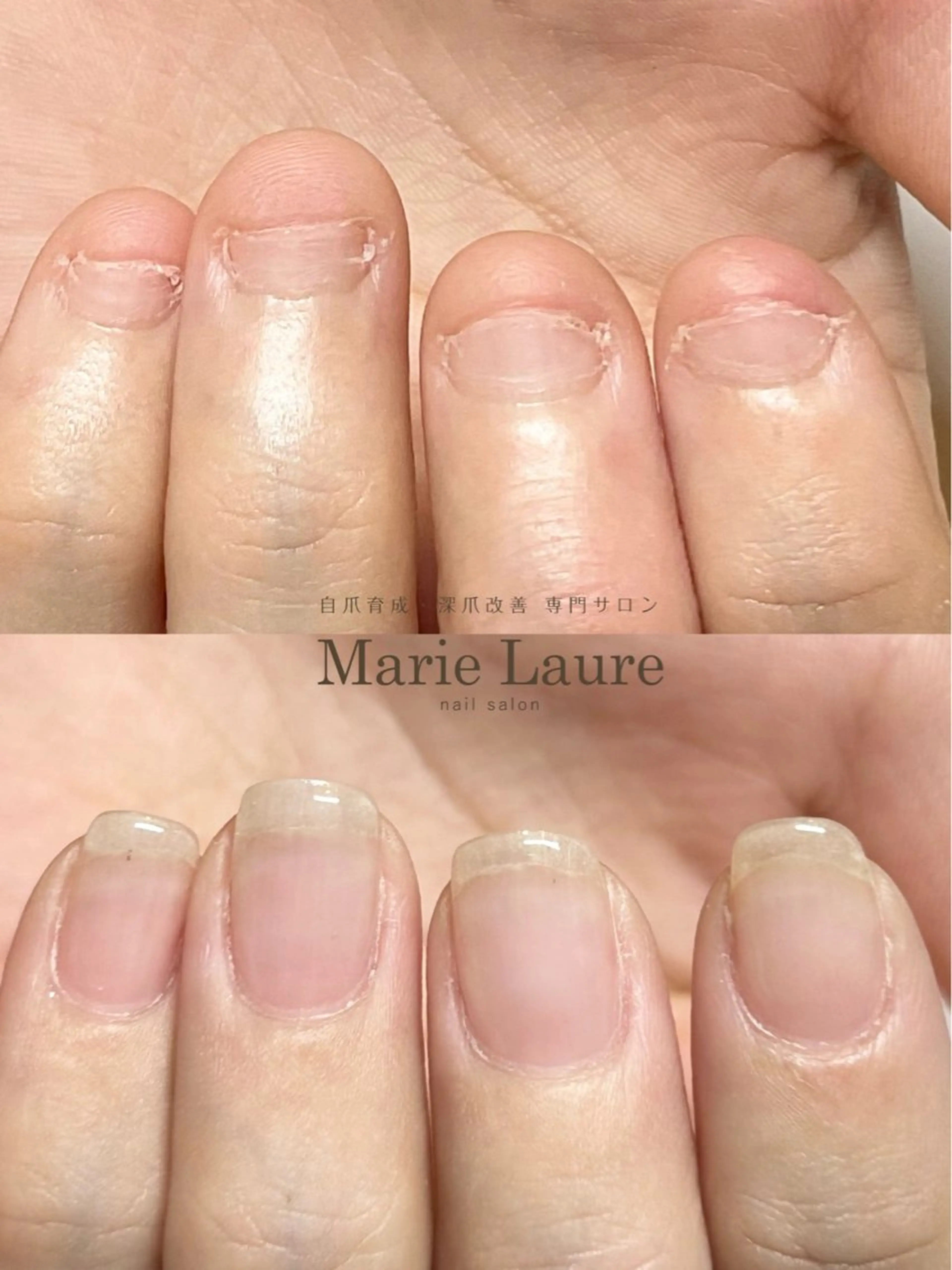 深爪矯正　長さだしの写真