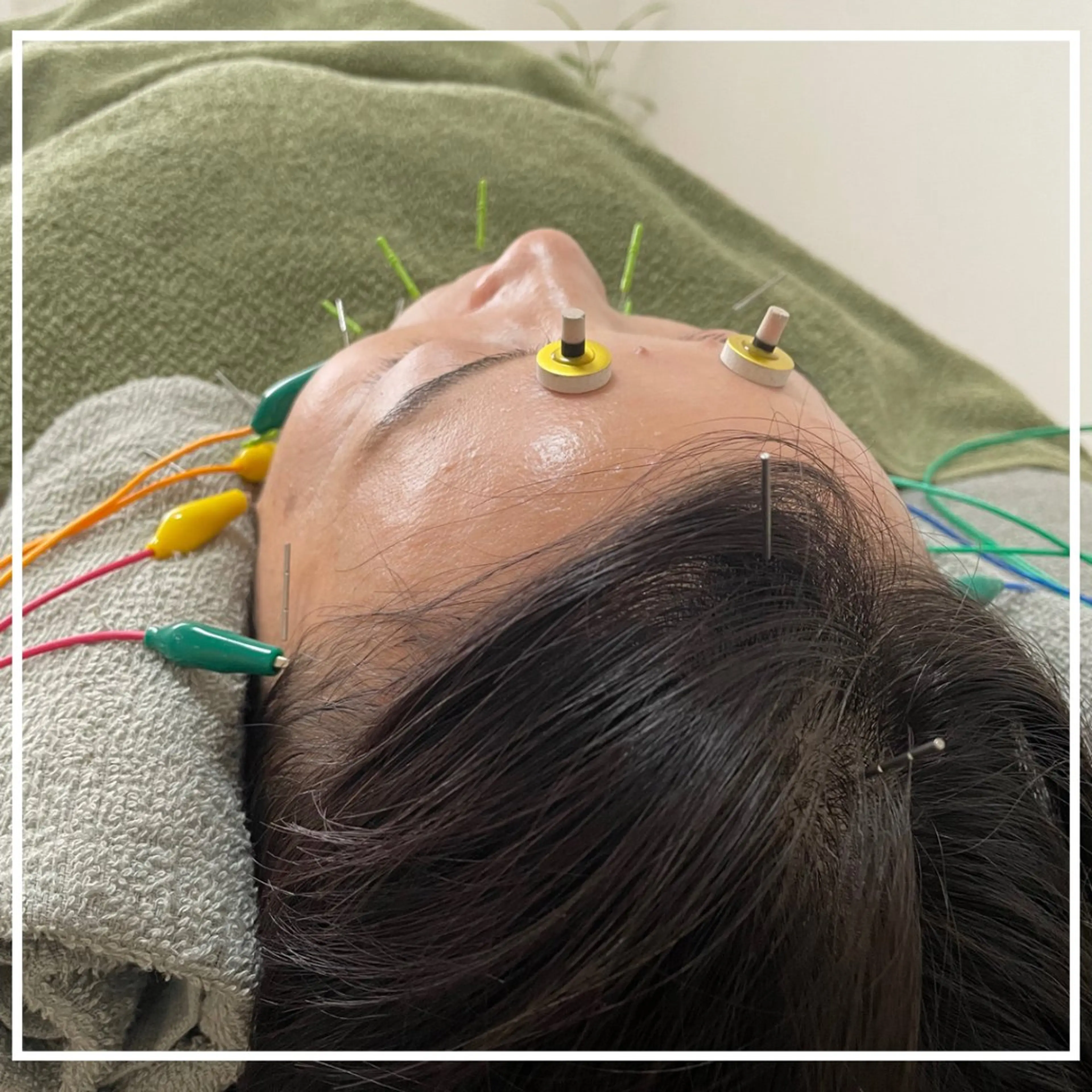 リフトアップして小顔に！シワも改善【美容鍼灸＋プチヘッドスパ】の写真