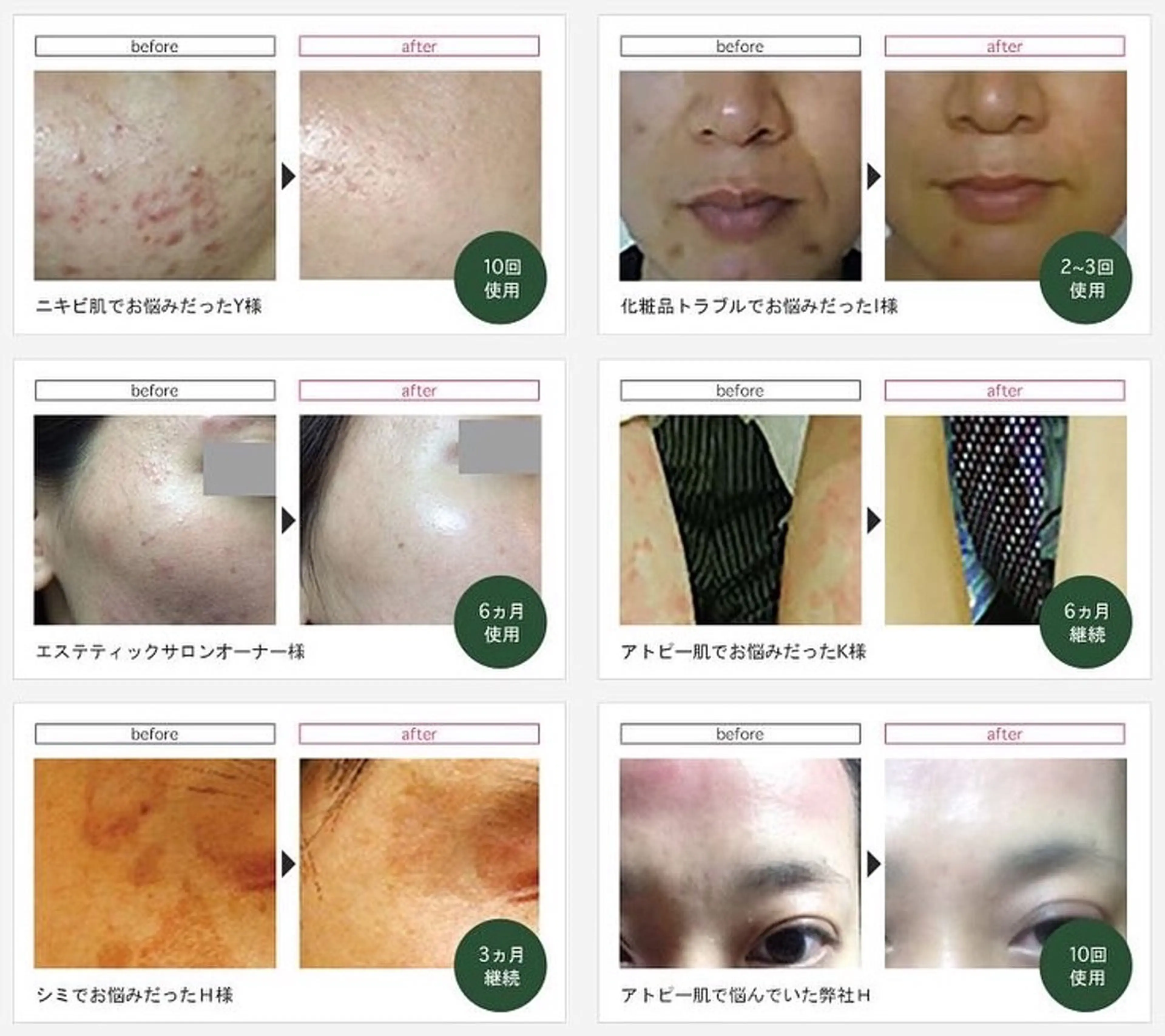 碧ハーブピーリング☆痛みなし☆ダウンタイムなし☆剥離なし☆当日メイク🆗☆即効性あり☆3日に1回施術🆗の写真