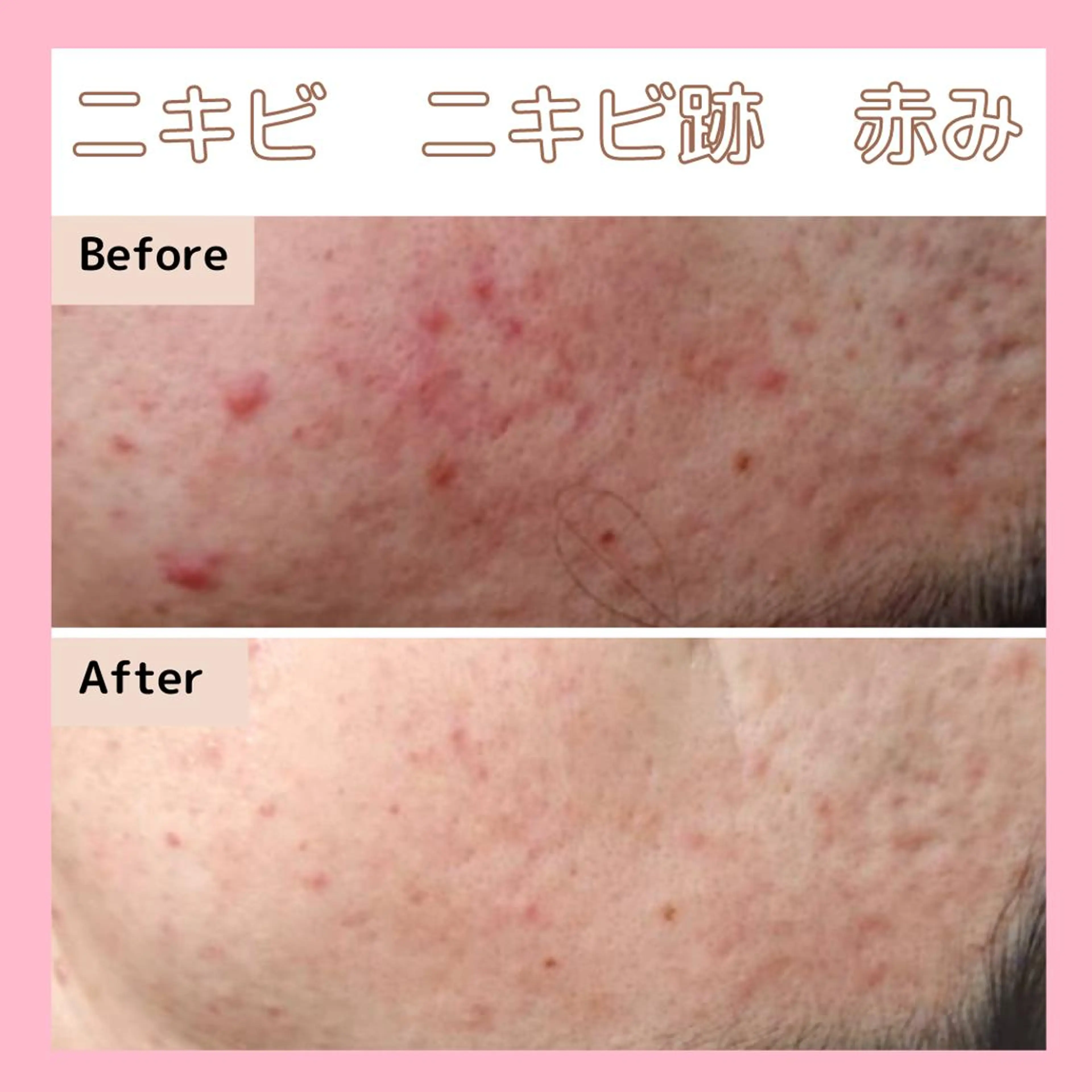 【諦めていたニキビ/ニキビ痕】細胞修復機器でお悩み卒業★の写真